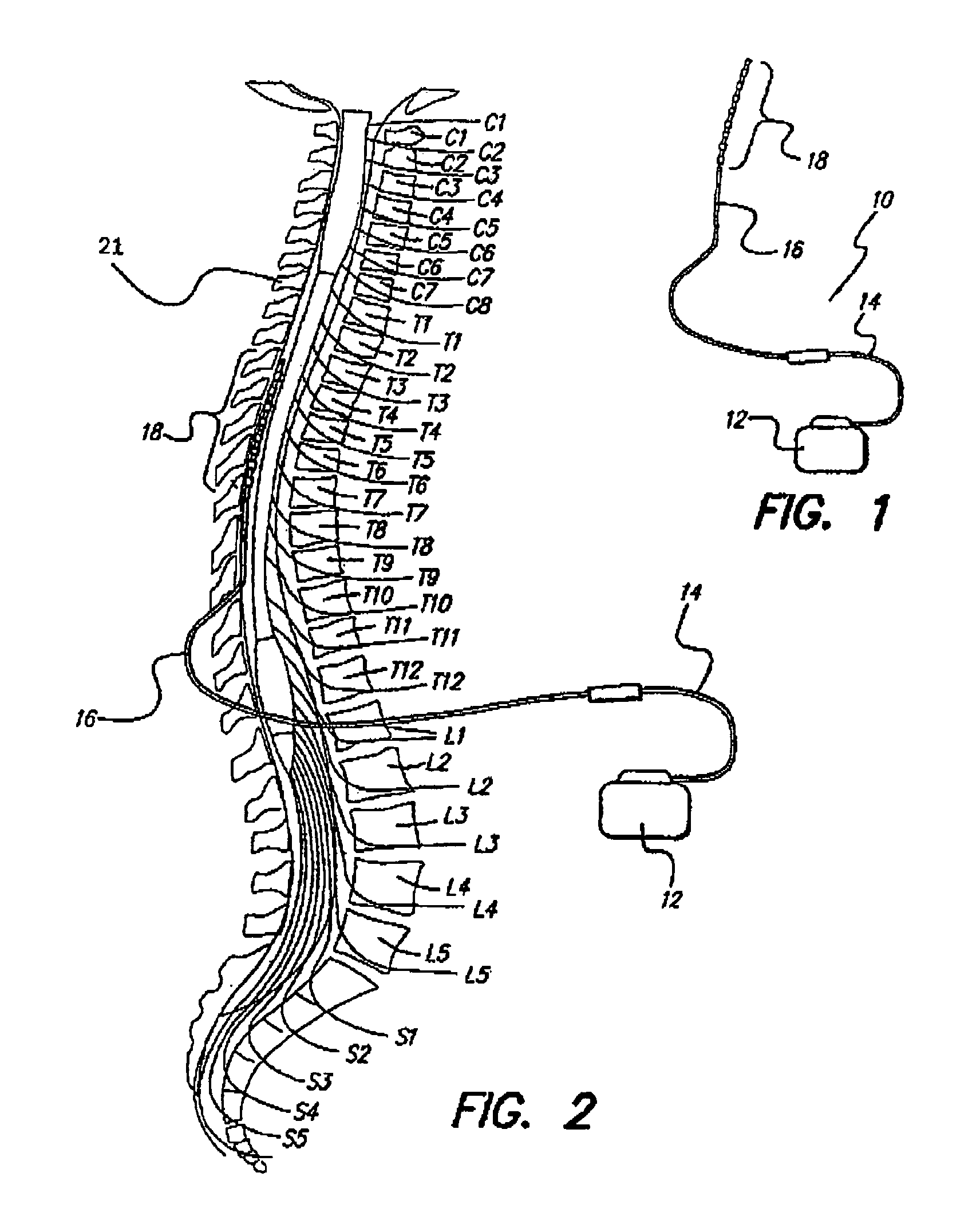 System and method of rapid, comfortable parameter switching in spinal cord stimulation