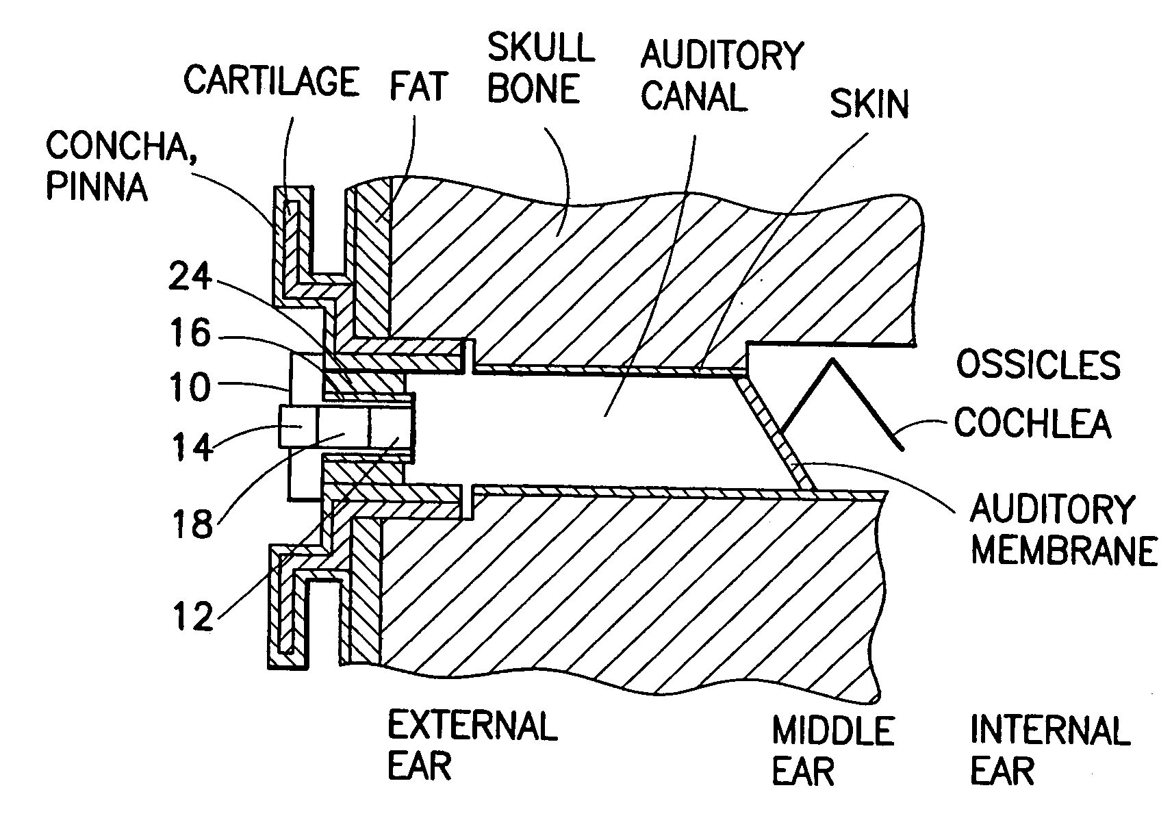 Ear-mounted transducer and ear-device