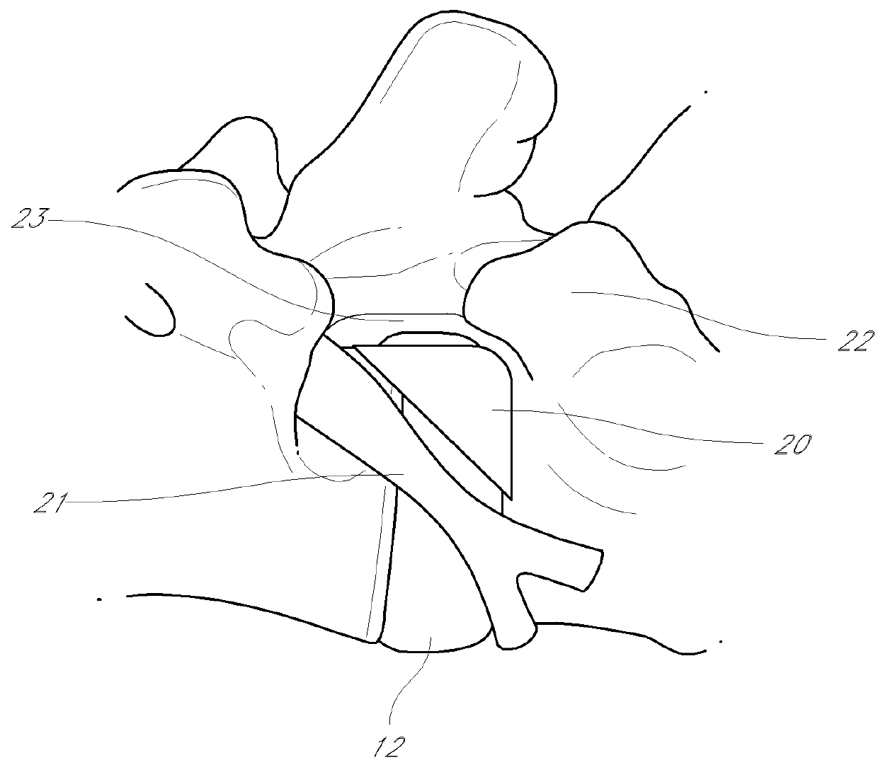 Method and apparatus for minimally invasive insertion of intervertebral implants