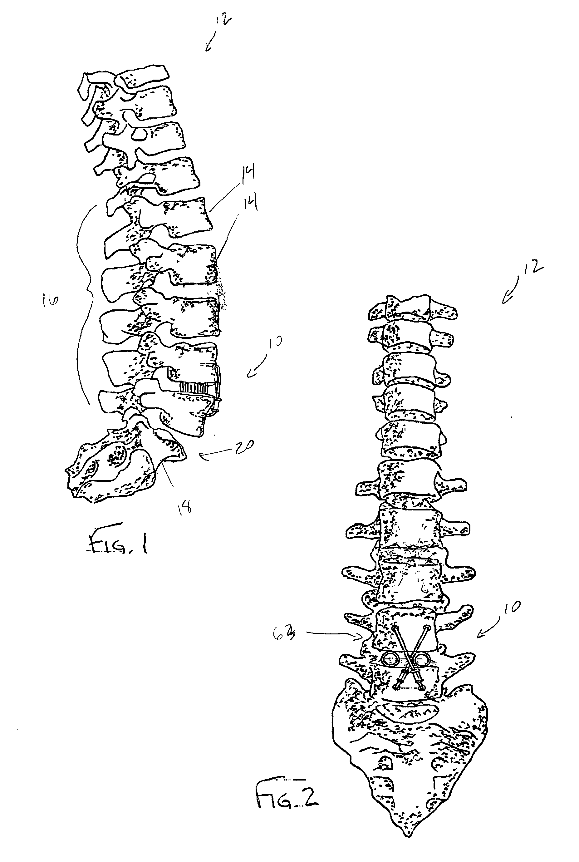System and method for bone fixation