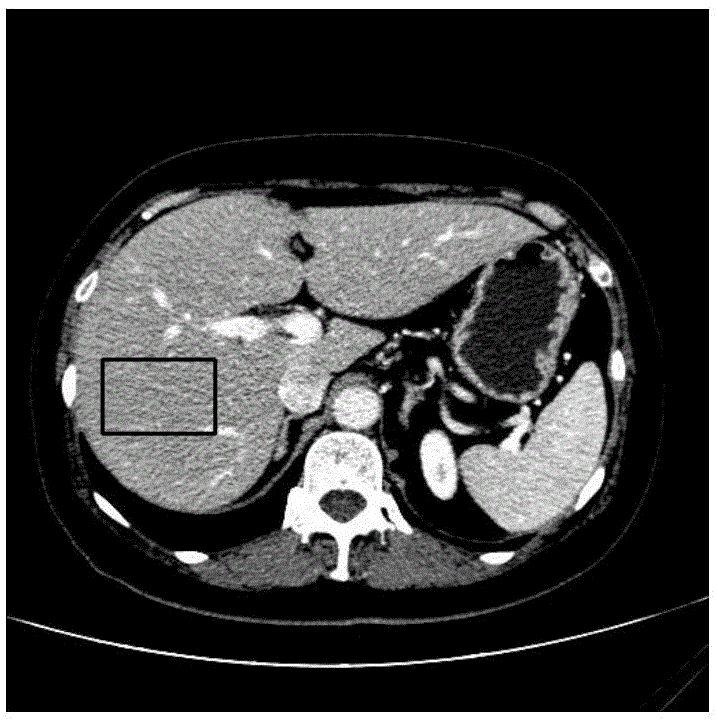 Rapid robustness auto-partitioning method for abdomen computed tomography (CT) sequence image of liver