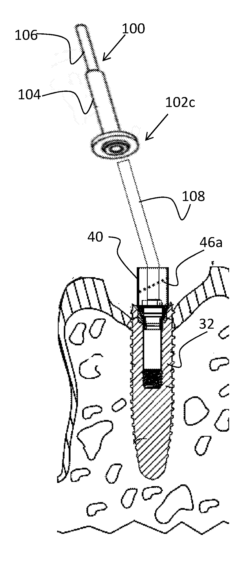 Dental Tool for Customizing Implants, System and Methods Thereof
