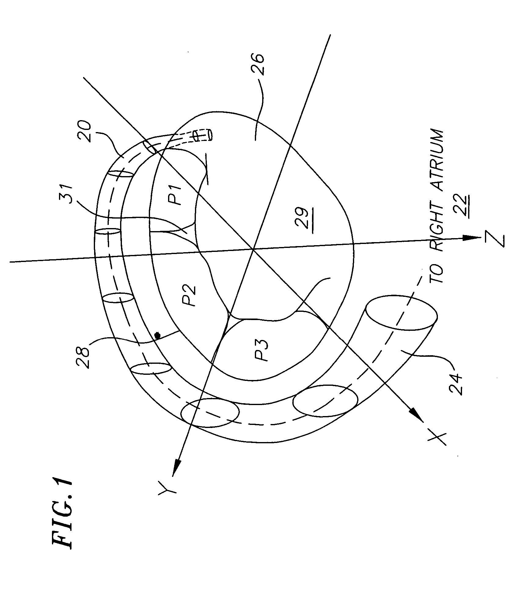 Device for changing the shape of the mitral annulus