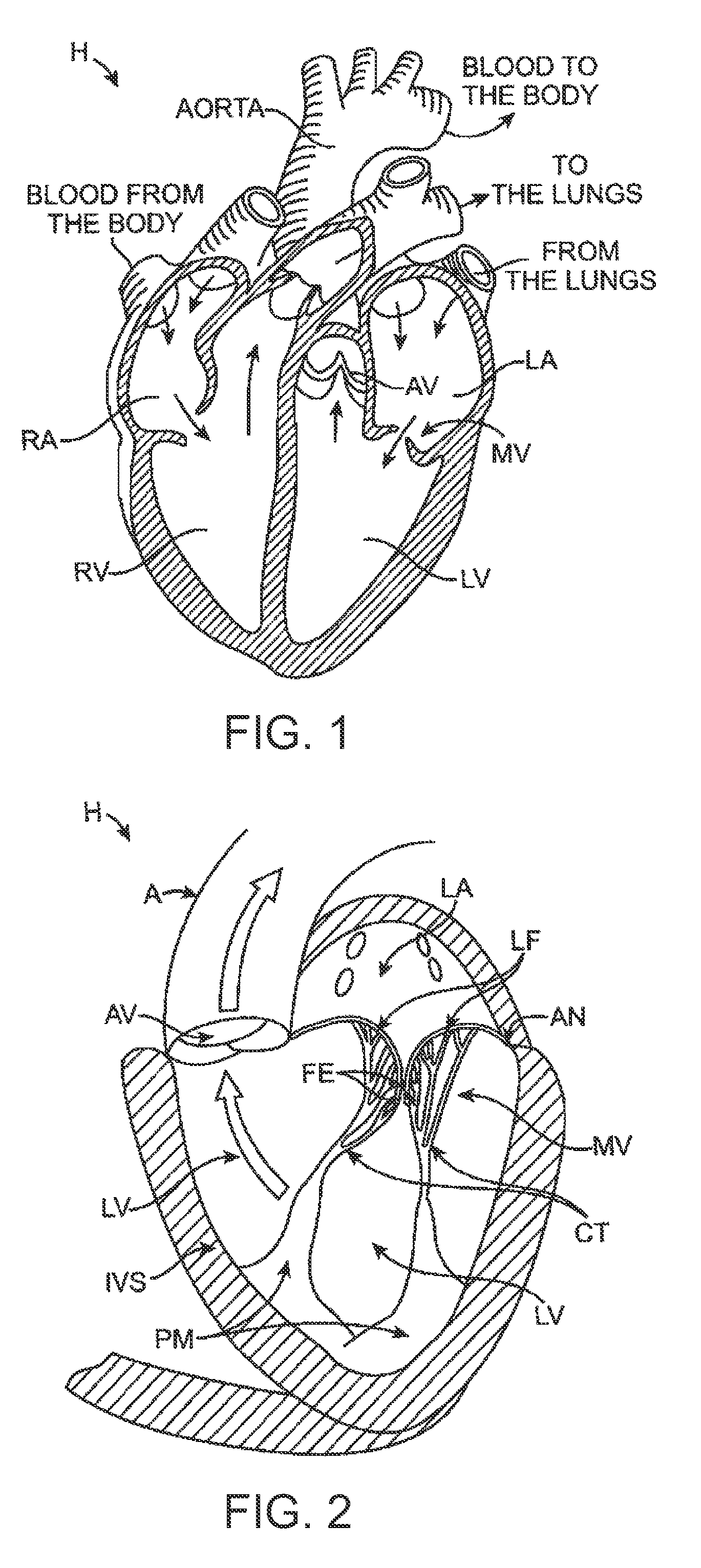 Prosthetic heart valve devices, prosthetic mitral valves and associated systems and methods