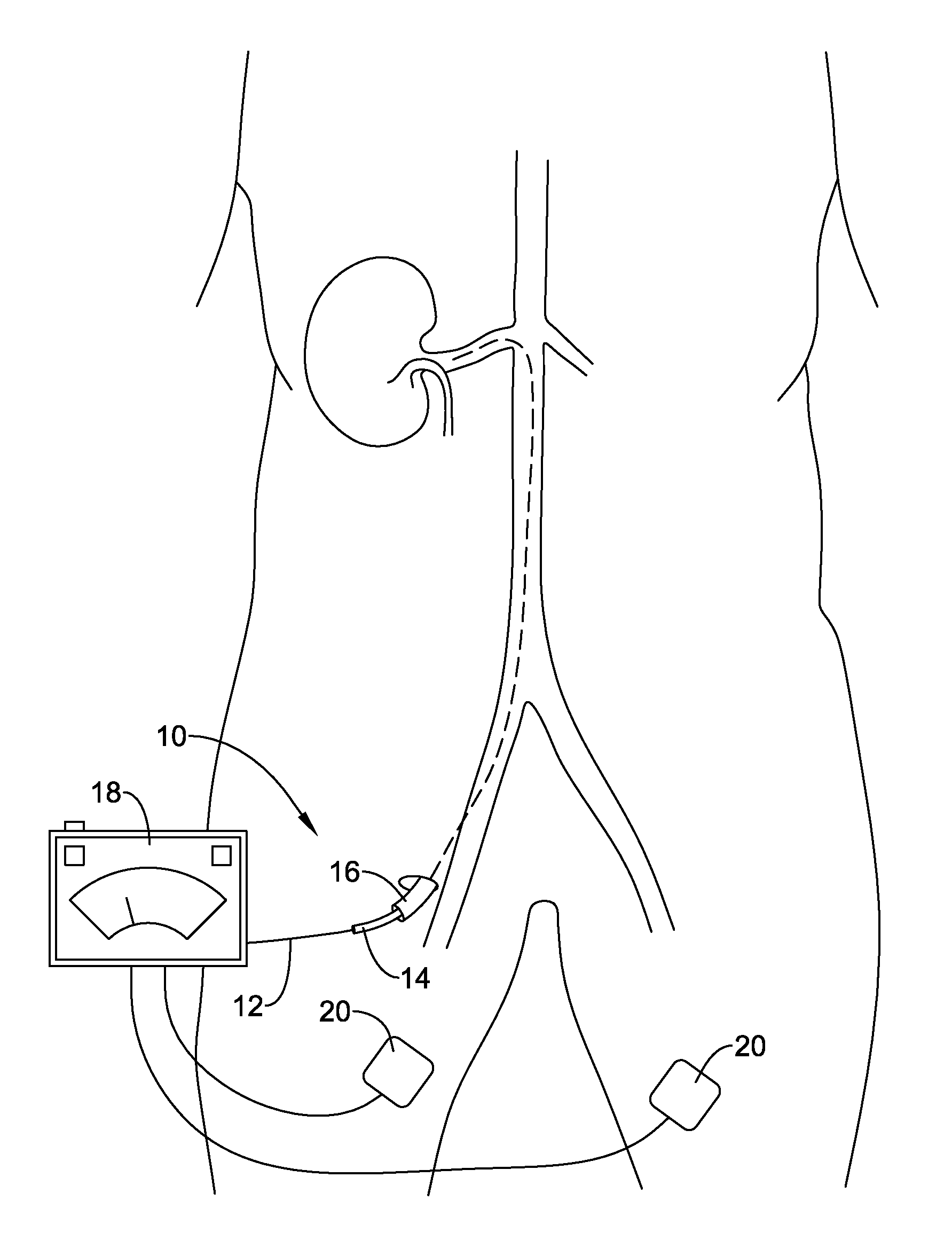 Device and methods for renal nerve modulation
