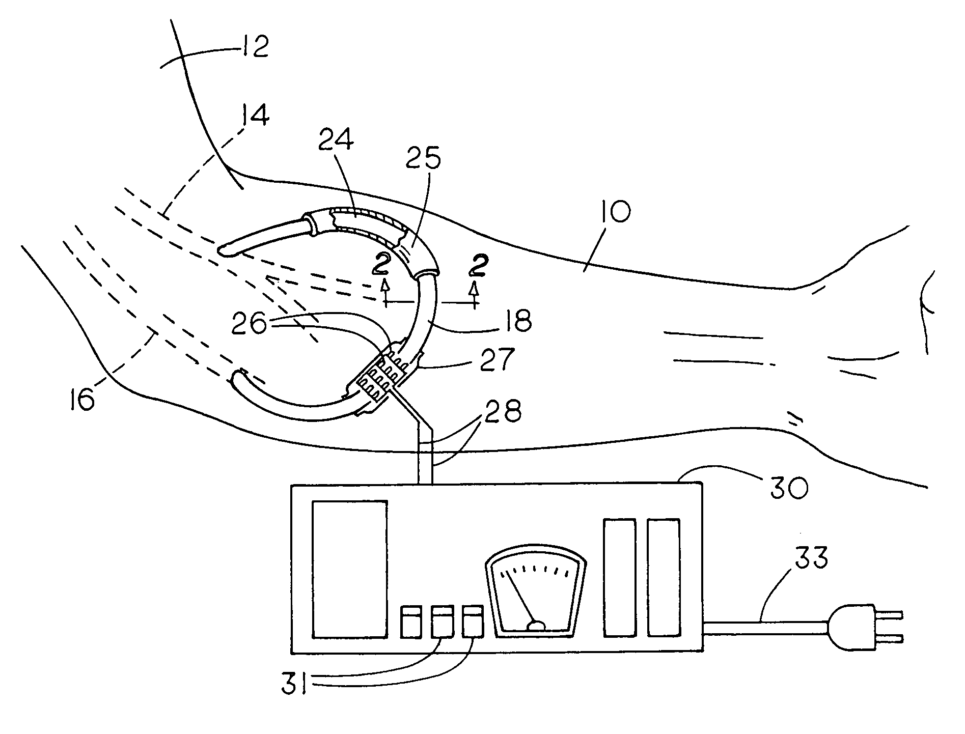 Method and apparatus for preventing dialysis graft intimal hyperplasia