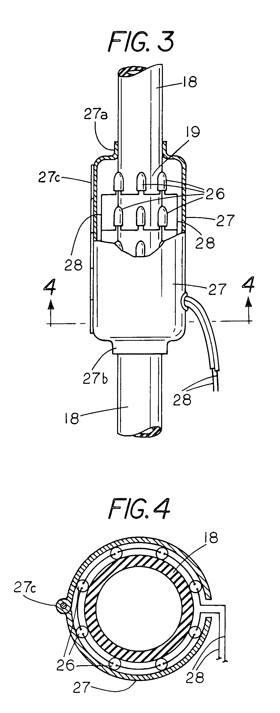 Method and apparatus for preventing dialysis graft intimal hyperplasia