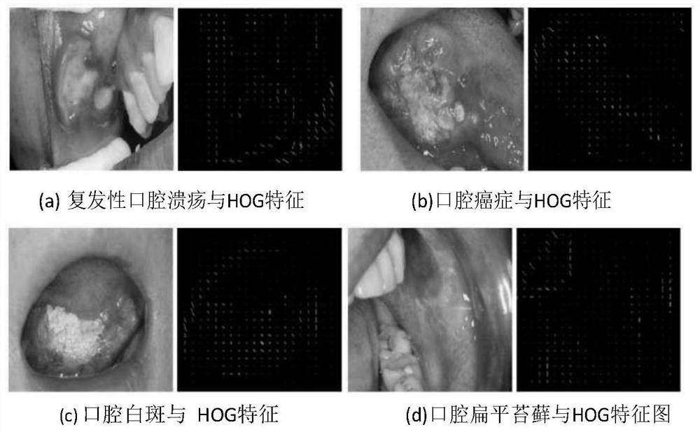 Oral mucosal disease recognition method based on deep learning multi-feature fusion