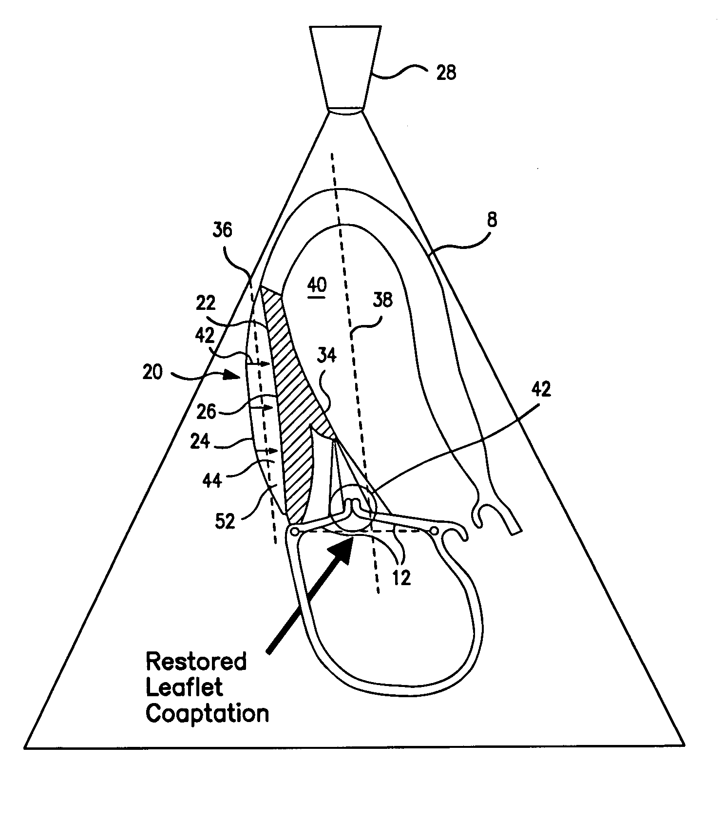 Systems for and methods of atrioventricular valve regurgitation and reversing ventricular remodeling