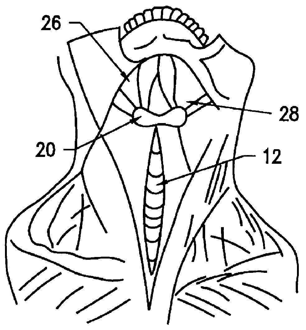 Hyoid expansion and suspension procedure