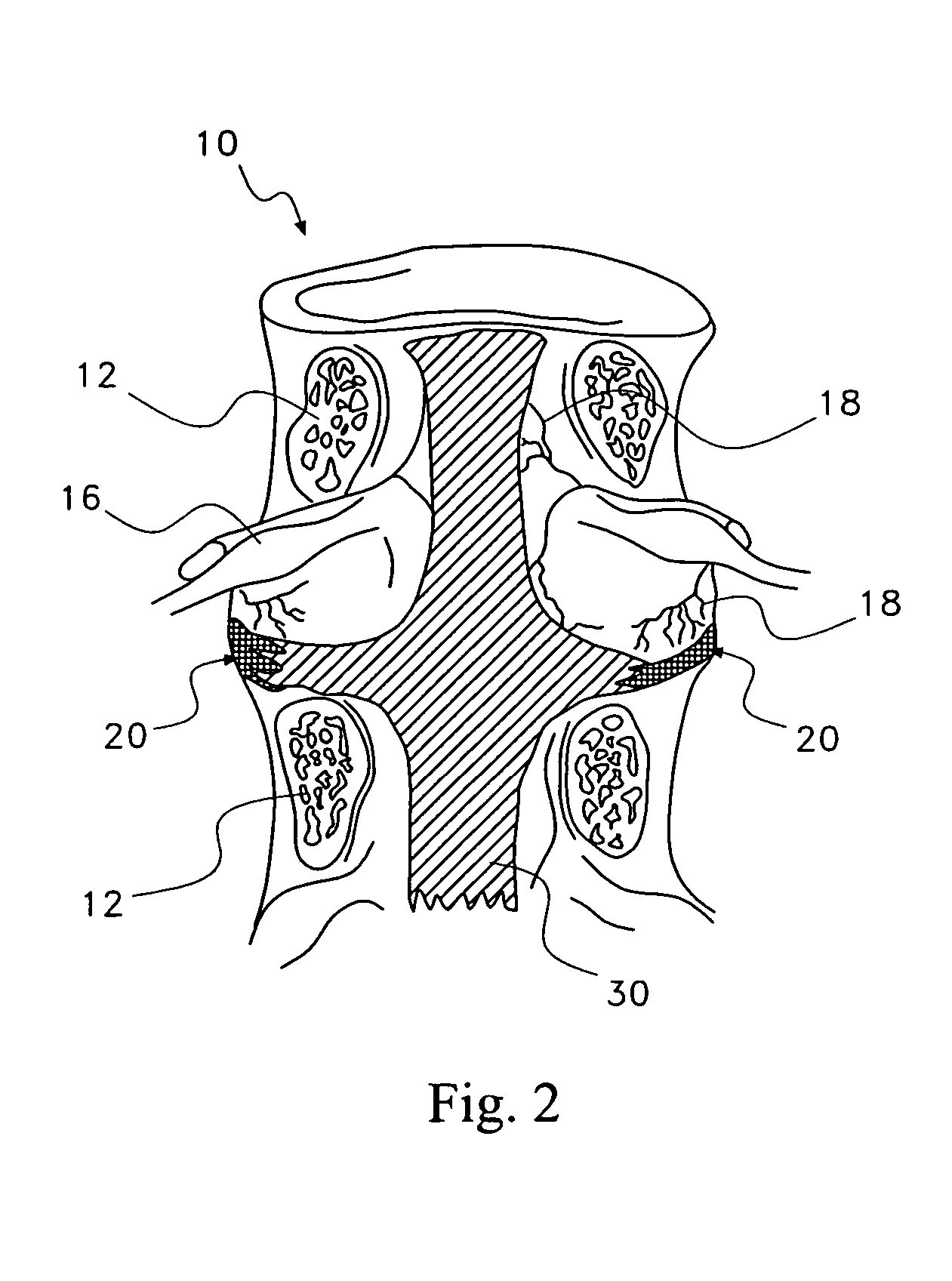 Pharmaceutical removal of vascular and/or neuronal extensions form a degenerating disc
