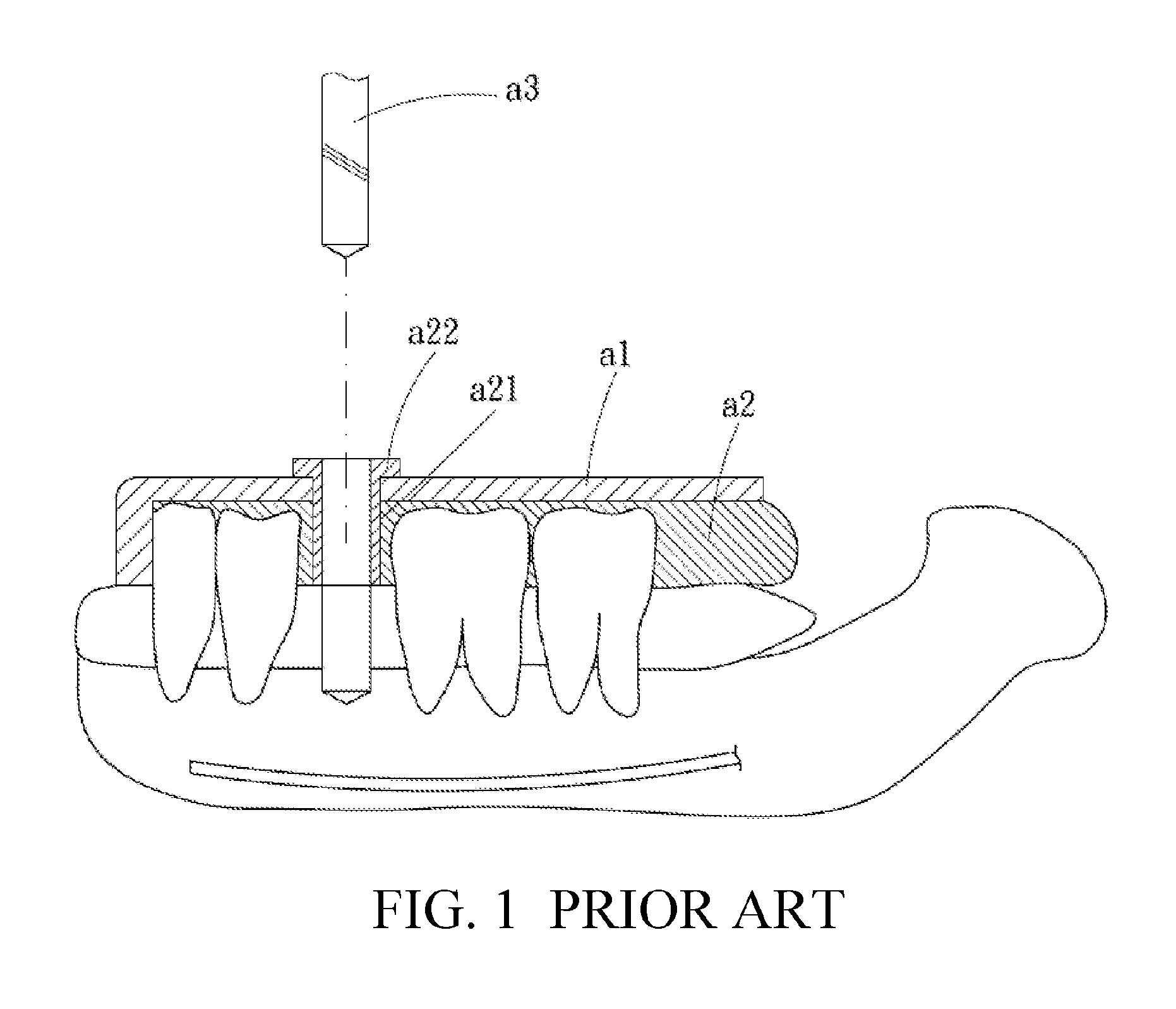 Dental positioning stent, and manufacturing method, using method and components for the same