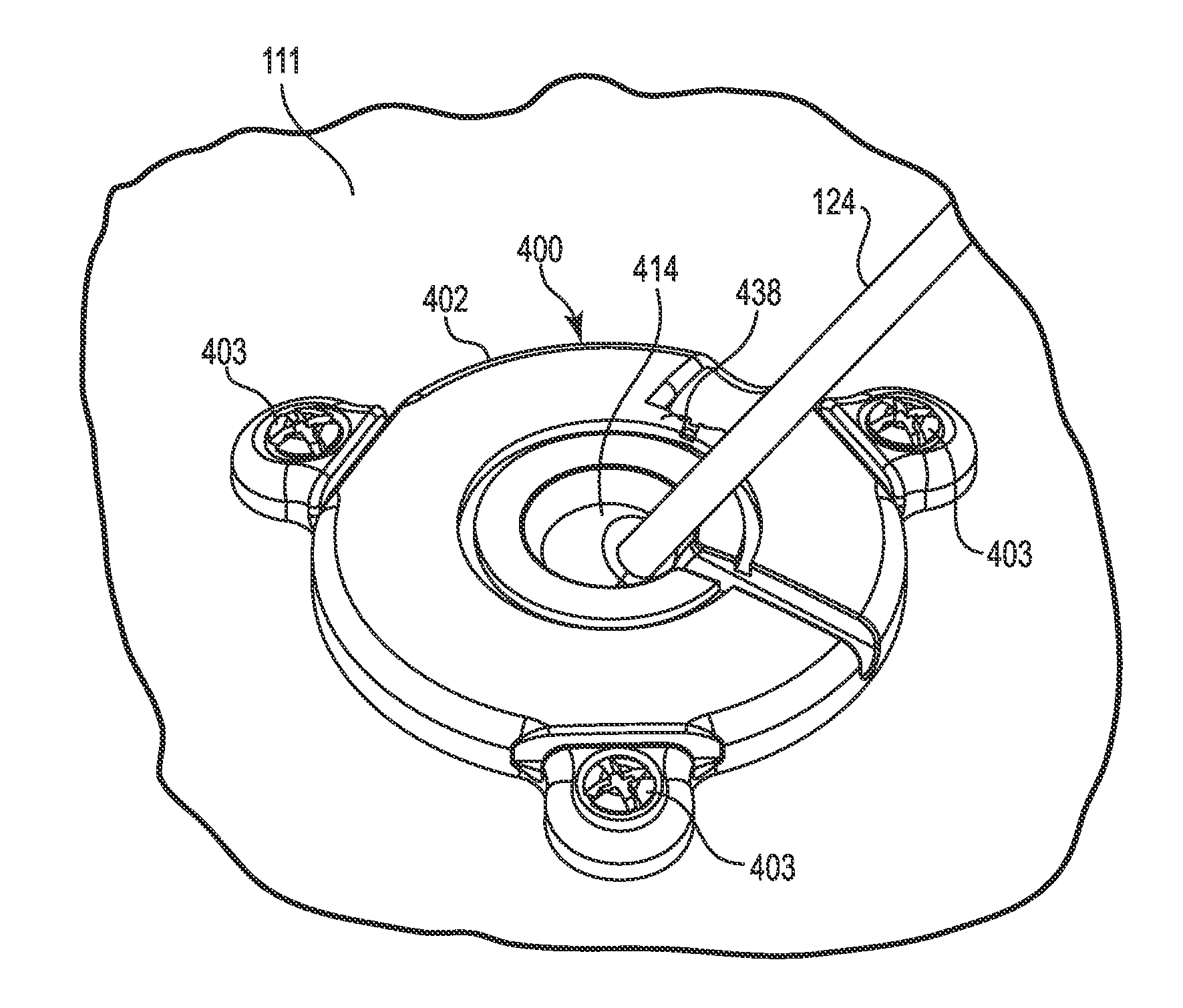 Socketed Portal Anchors and Methods of Using Same