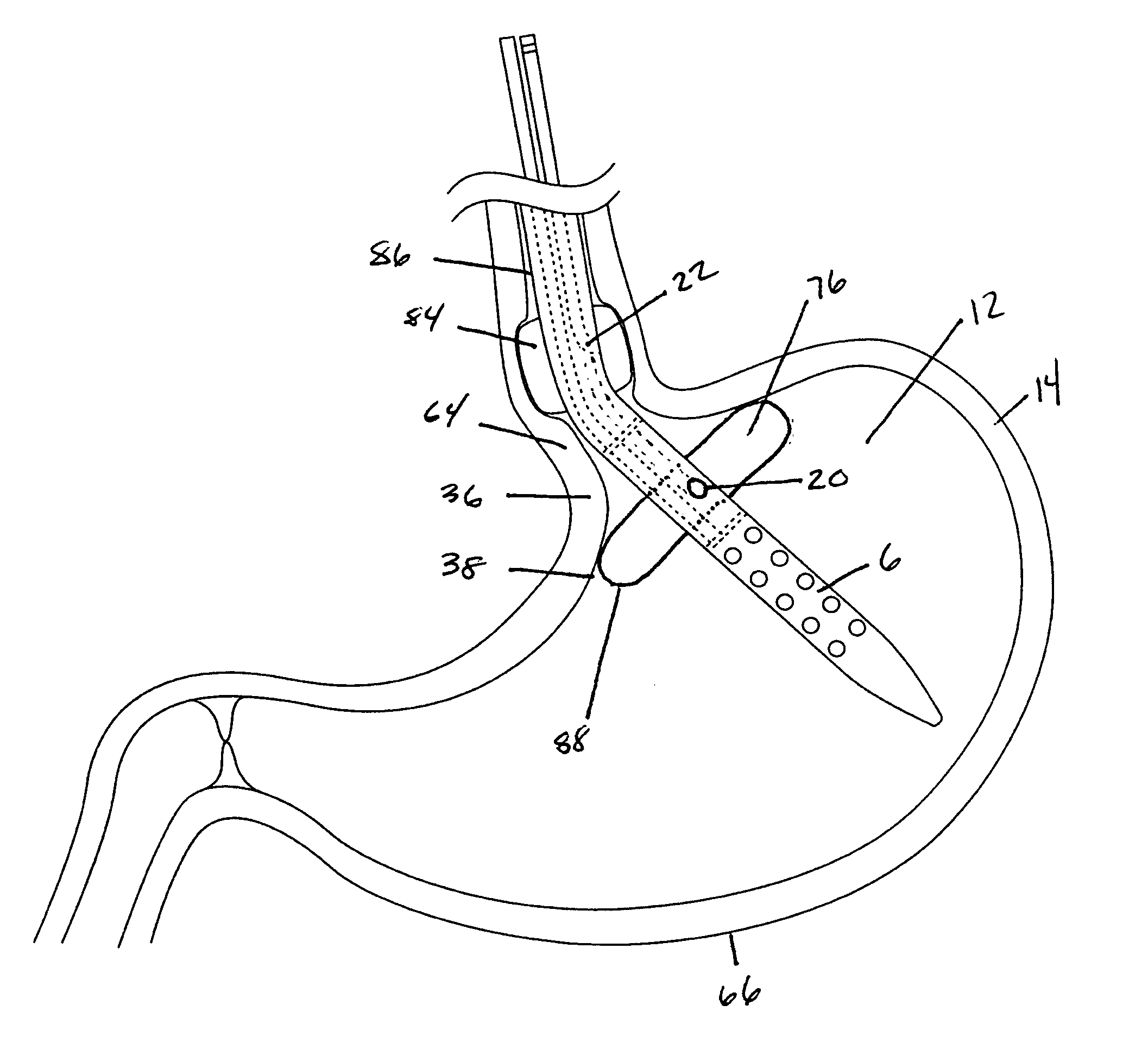 Nasogastric tube anti aspiration device