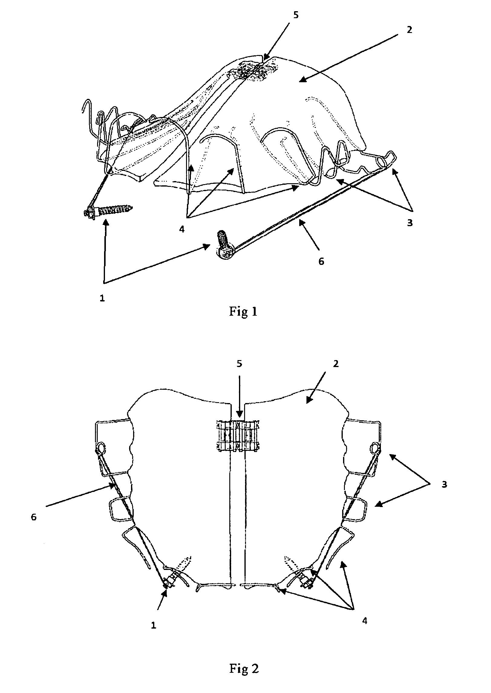Method and system for treatment of maxillary deficiency using miniscrews
