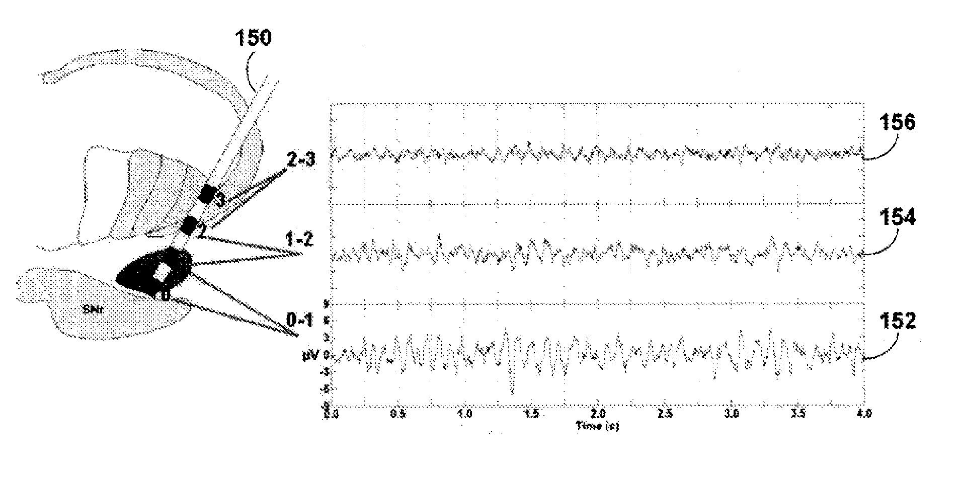Medical method and device for monitoring a neural brain network