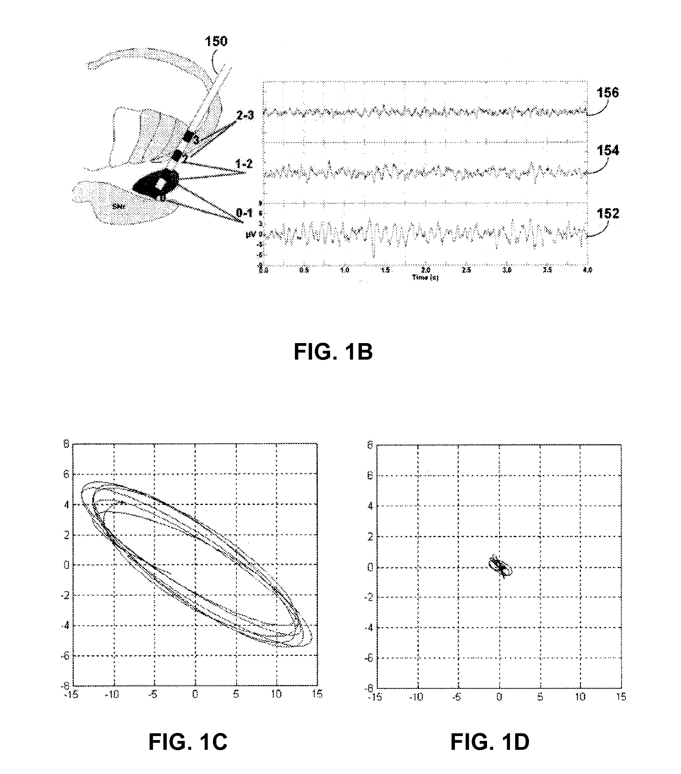 Medical method and device for monitoring a neural brain network
