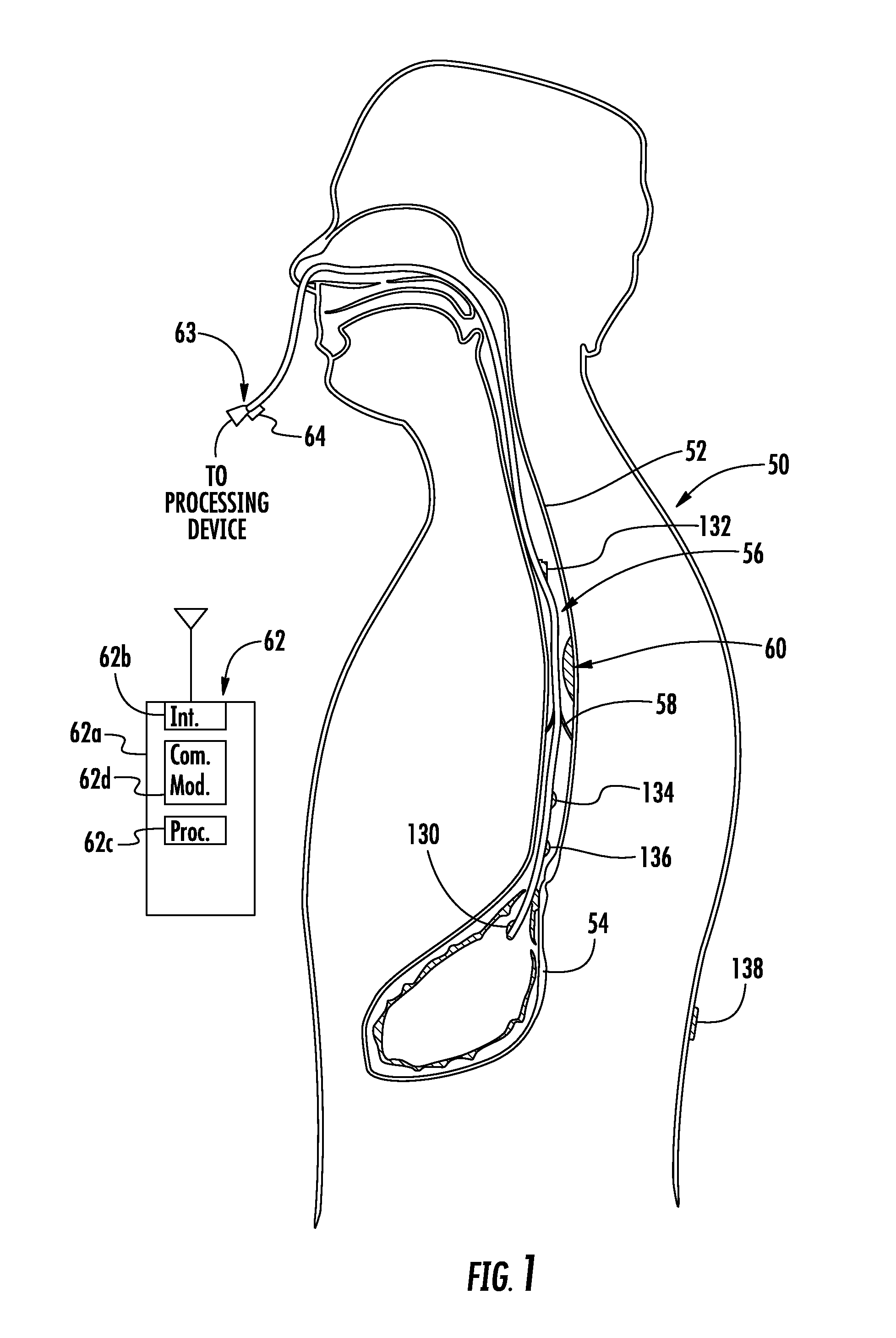 Device with passive valve to block emesis and/or reflux and associated system and method
