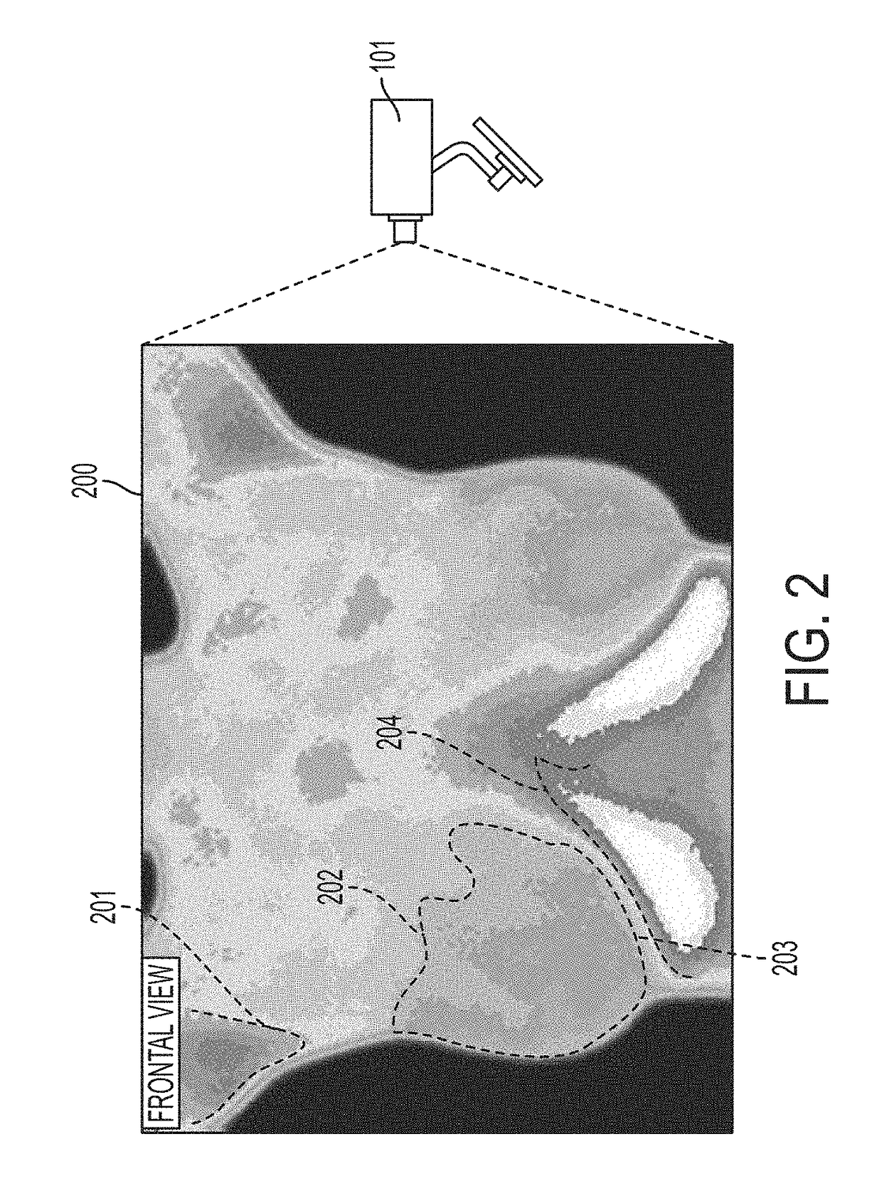 Automatic segmentation of breast tissue in a thermographic image