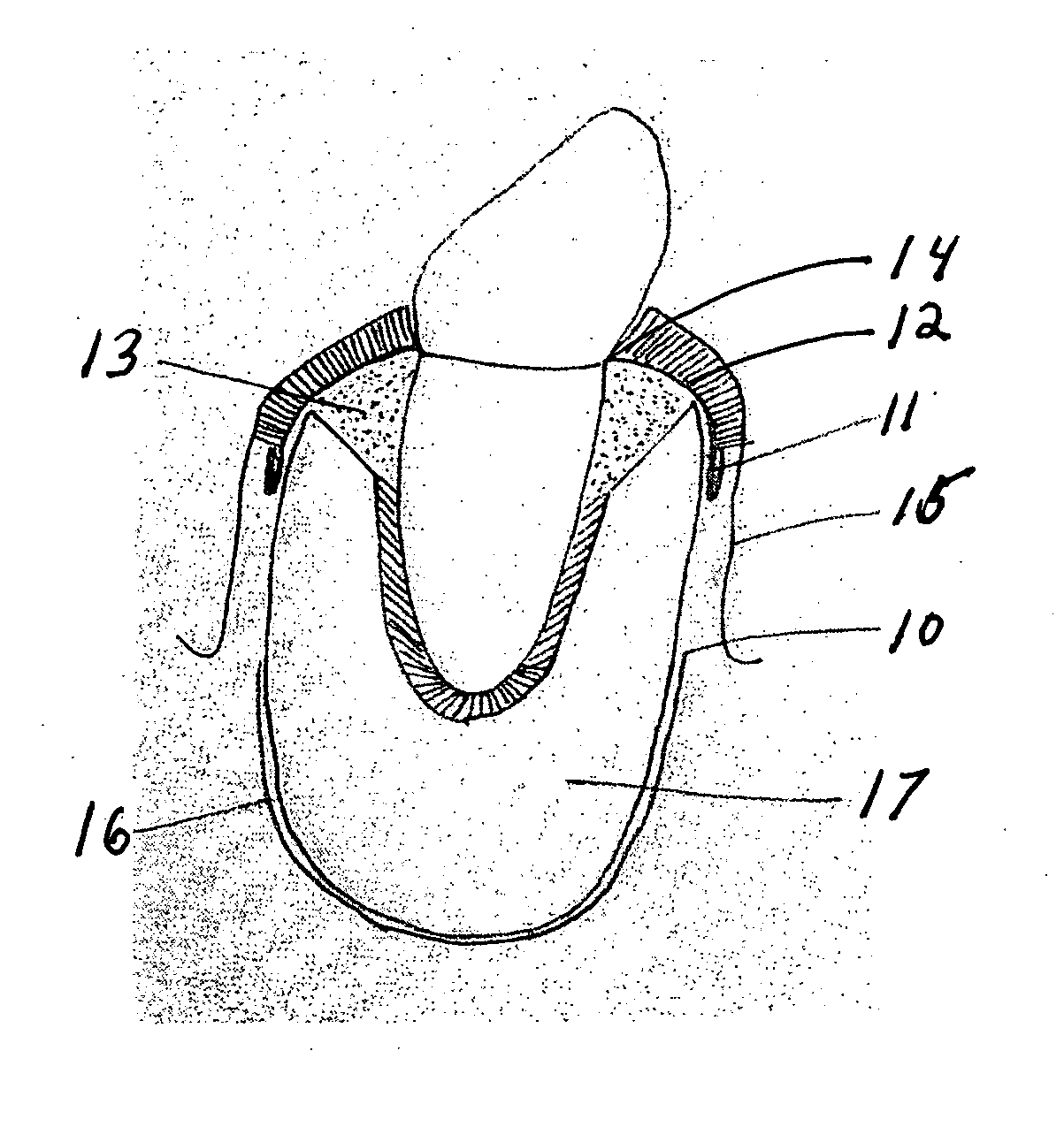 Method for regenerating bone