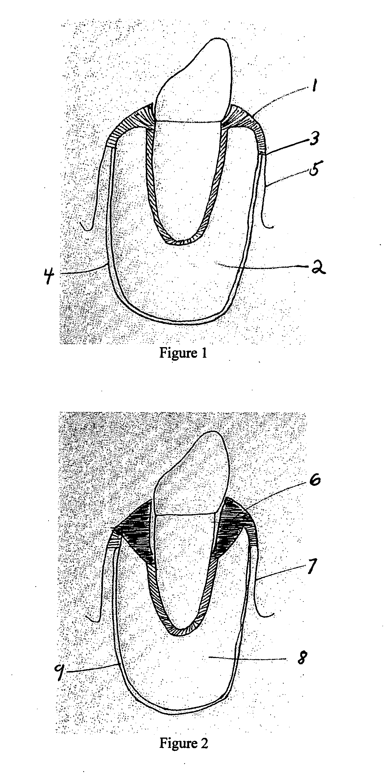 Method for regenerating bone