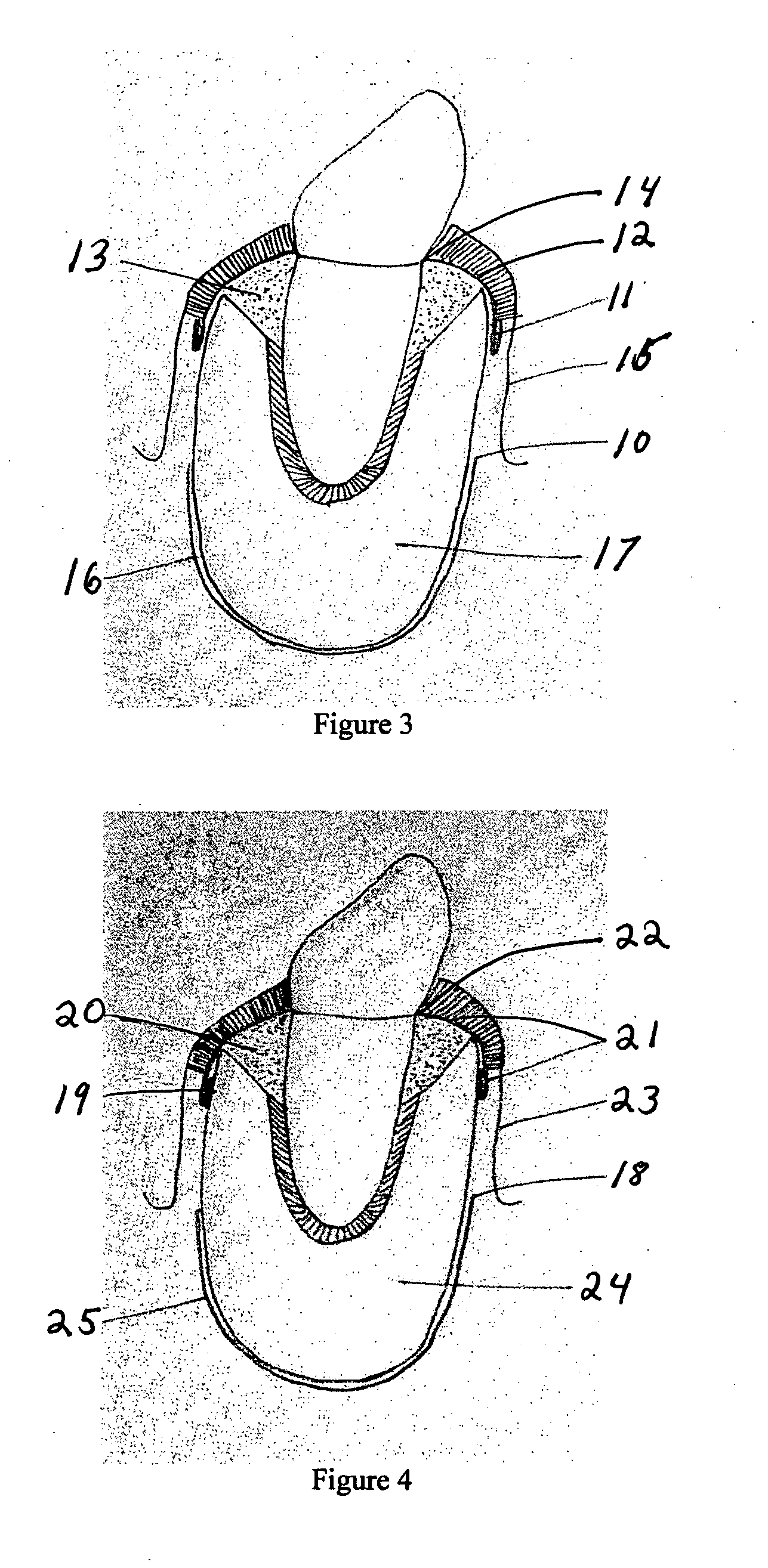 Method for regenerating bone