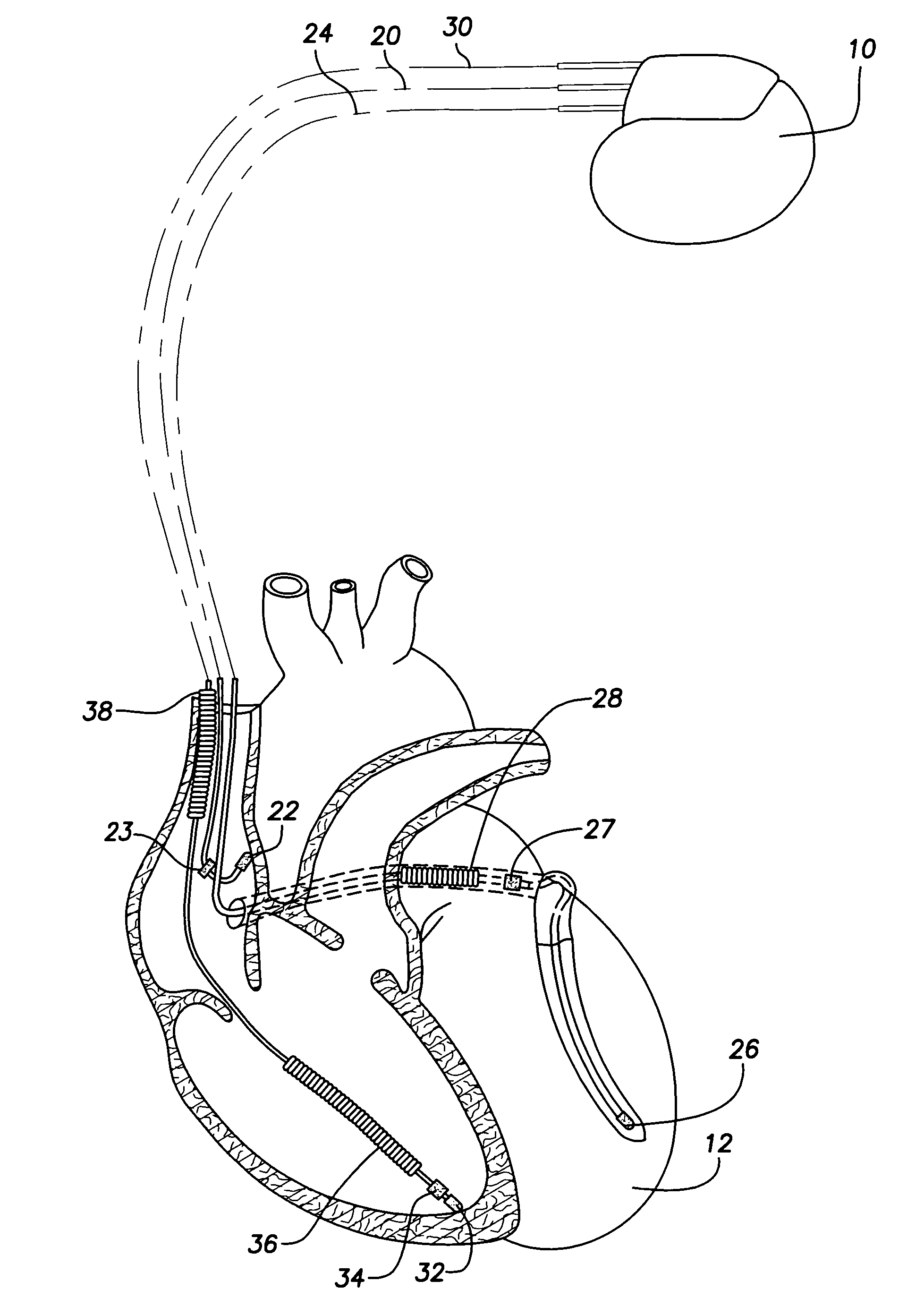 System and method for providing preventive overdrive pacing and antitachycardia pacing using an implantable cardiac stimulation device