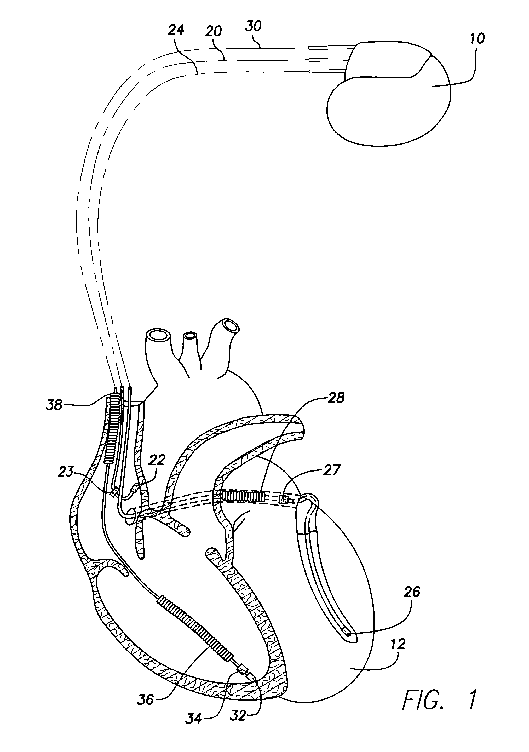 System and method for providing preventive overdrive pacing and antitachycardia pacing using an implantable cardiac stimulation device