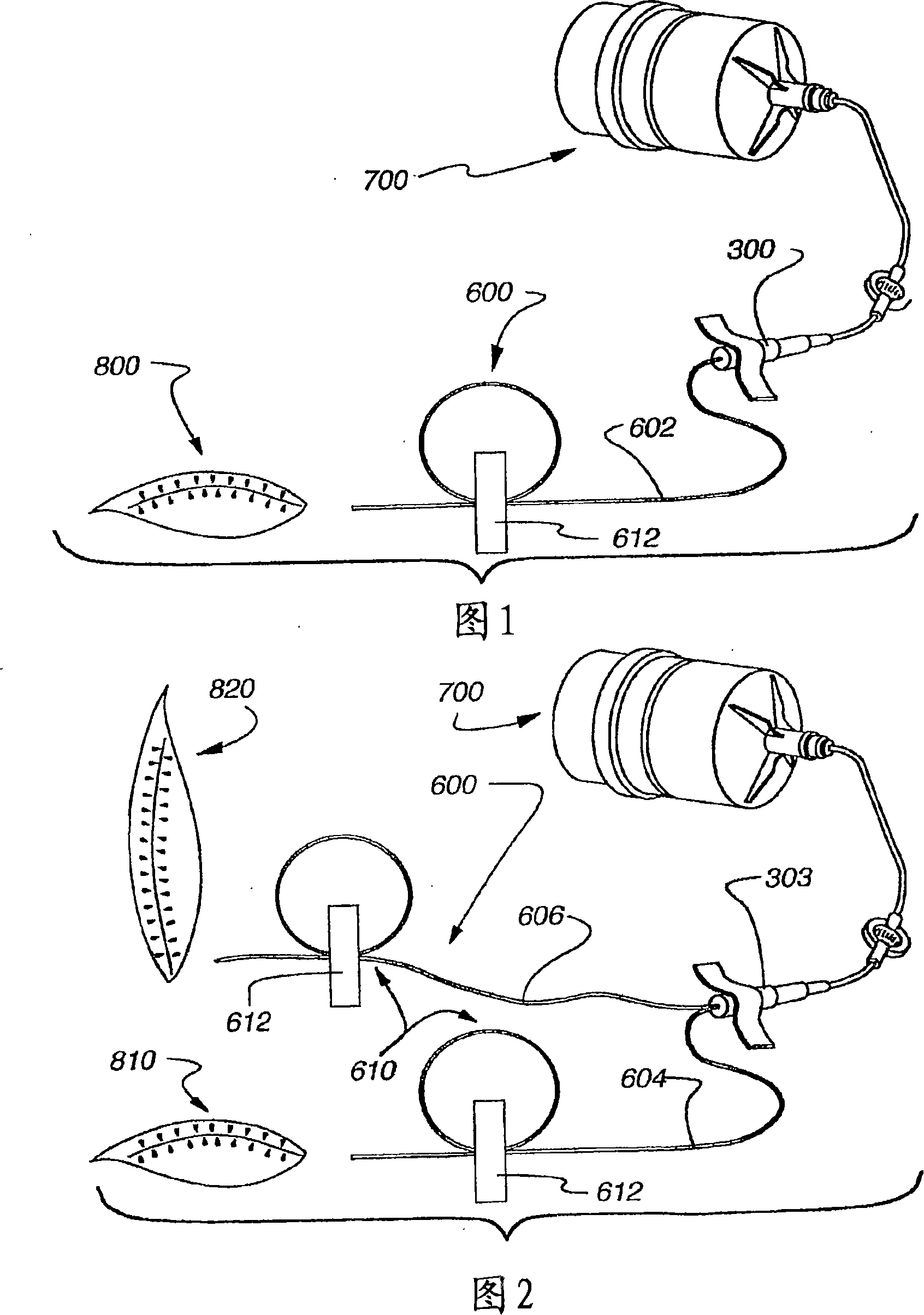 Adjustable infusion catheter