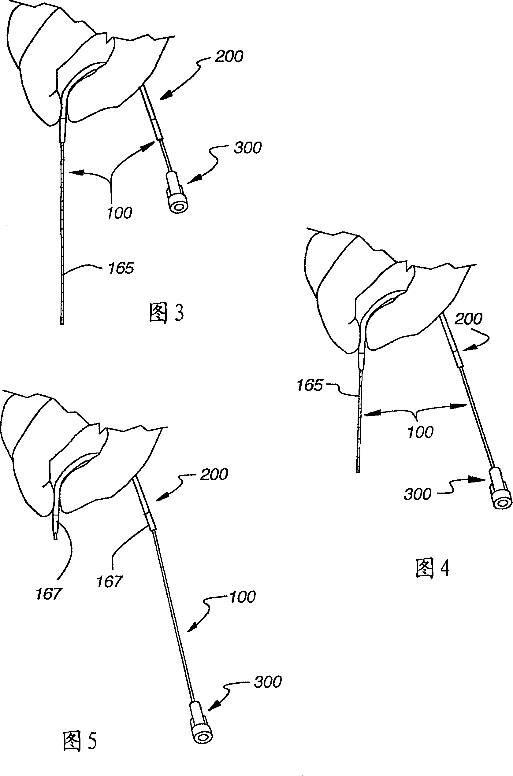 Adjustable infusion catheter