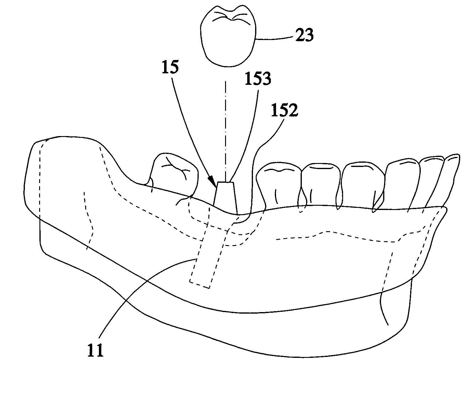 Method for designing a digital abutment for dental implant