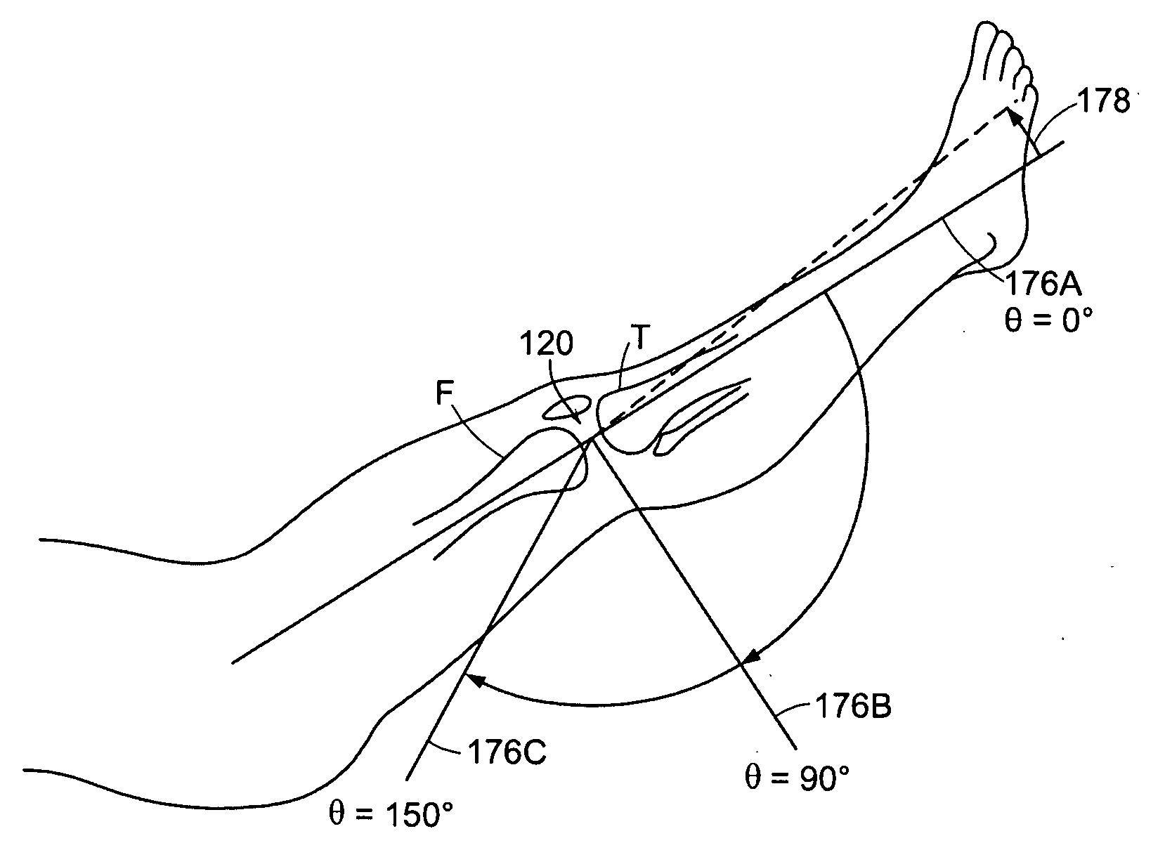 Implant planning using corrected captured joint motion information