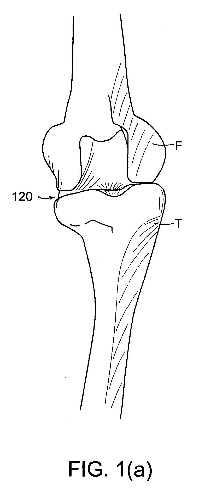 Implant planning using corrected captured joint motion information