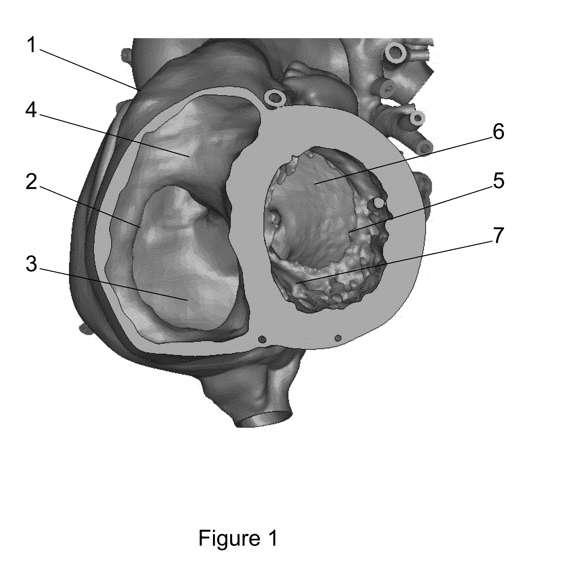 Patient-specific intraluminal implants