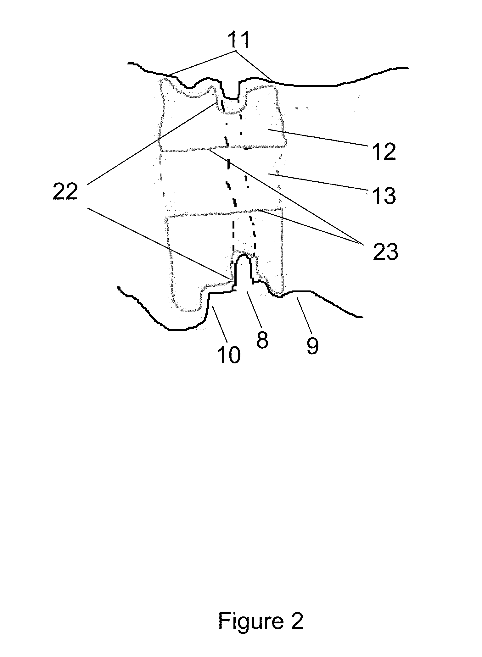 Patient-specific intraluminal implants