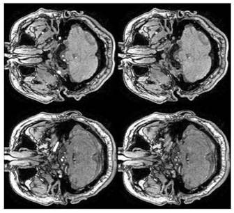 Cerebrovascular image segmentation method based on statistical model and multi-scale filtering