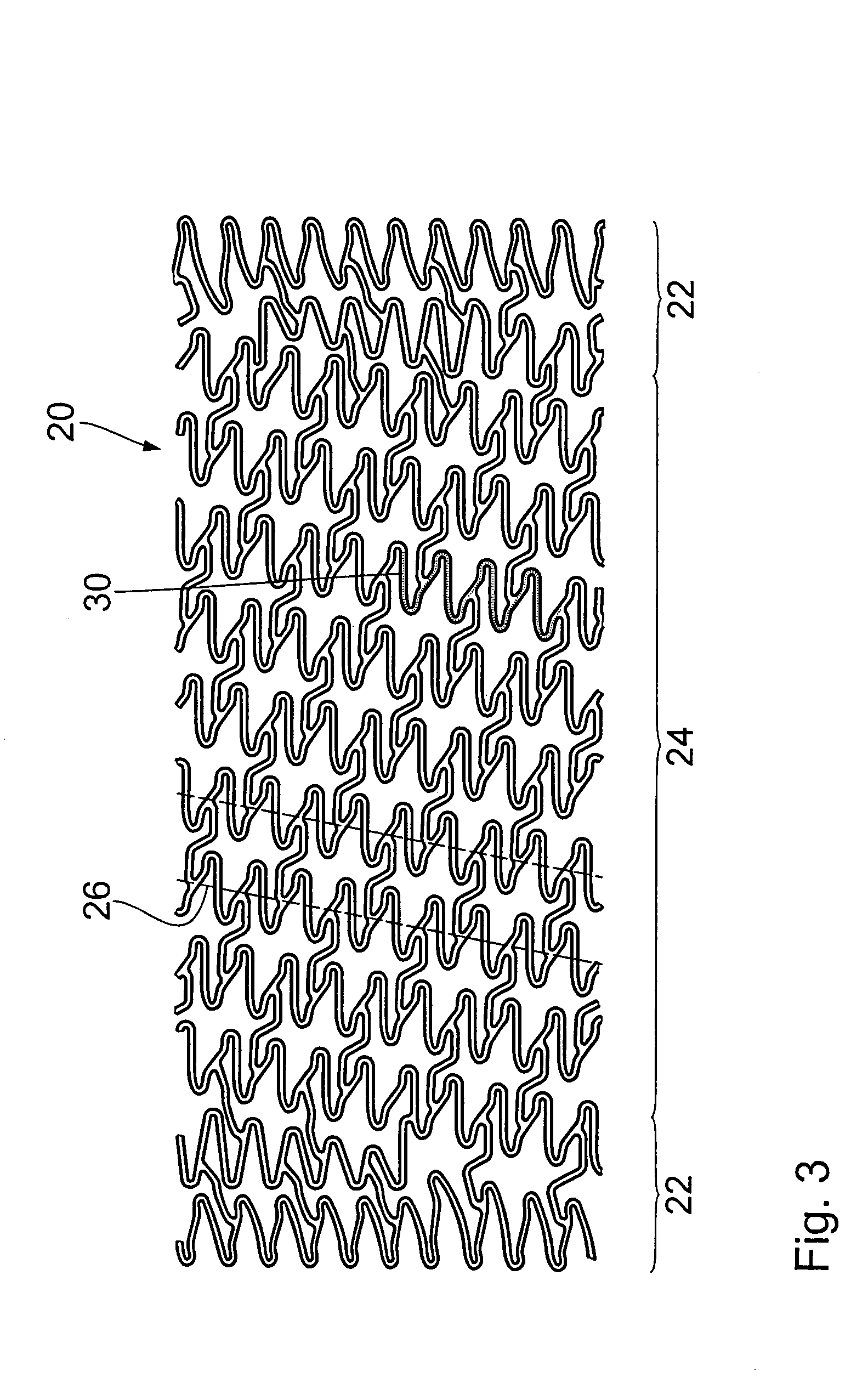 Stent