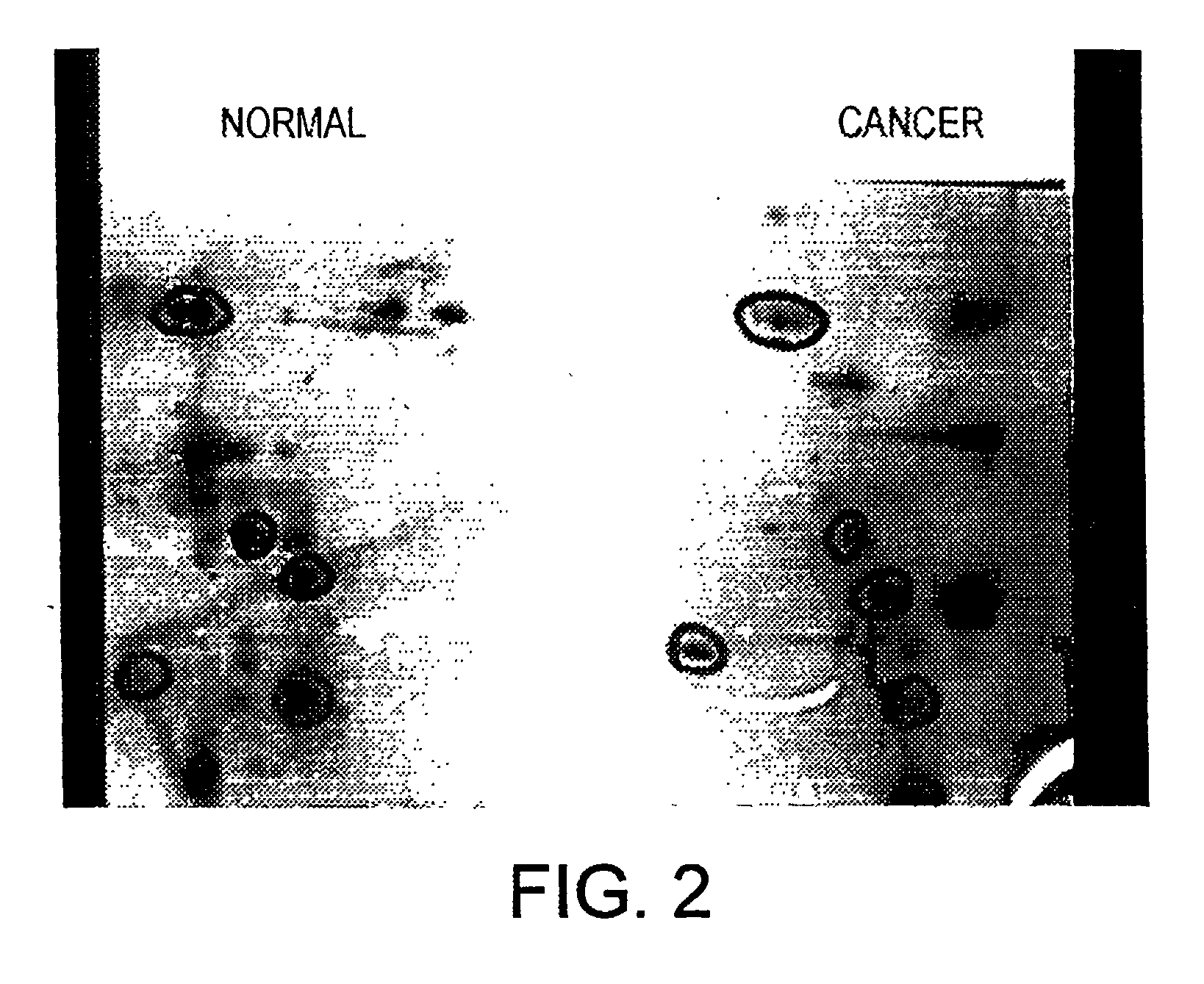 Altered DNA synthesome components as biomarkers for malignancy