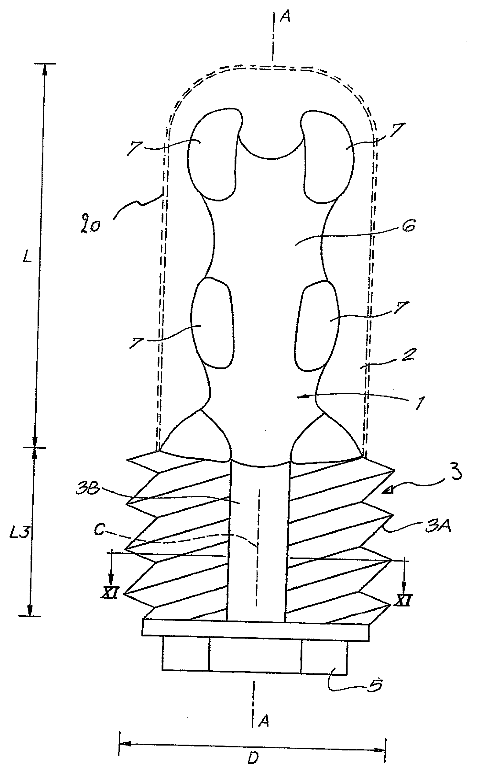 Bone implant