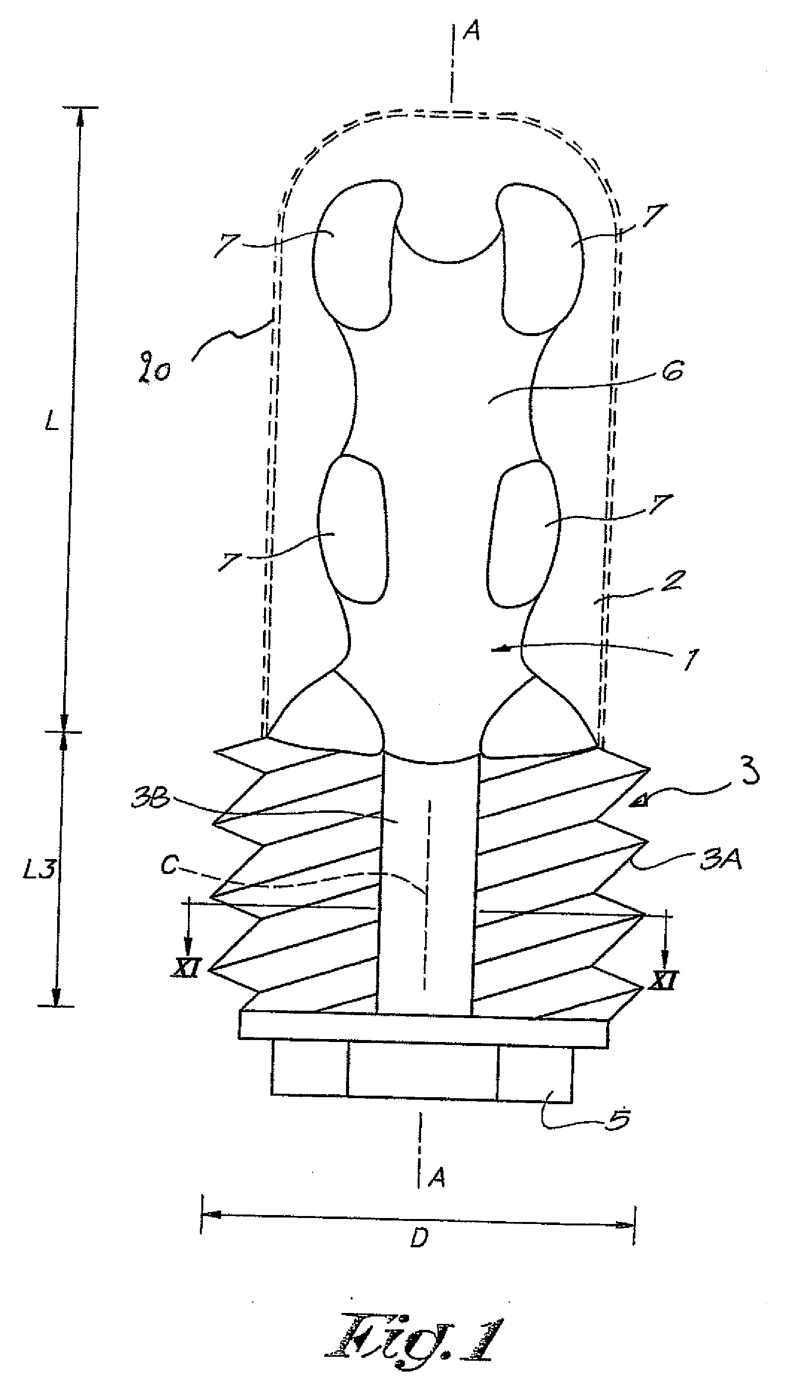 Bone implant