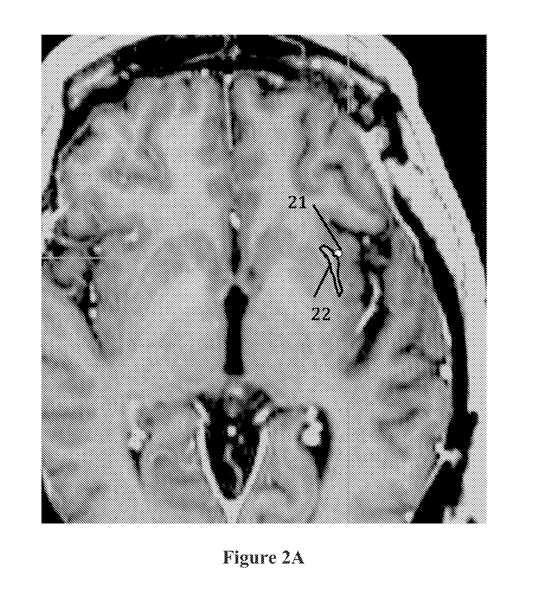 Electrical stimulation of the claustrum/piriform cortex for treatment of epilepsy