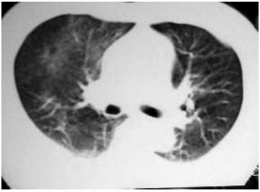 Lung tumor recognition method based on support vector machine MRI image segmentation