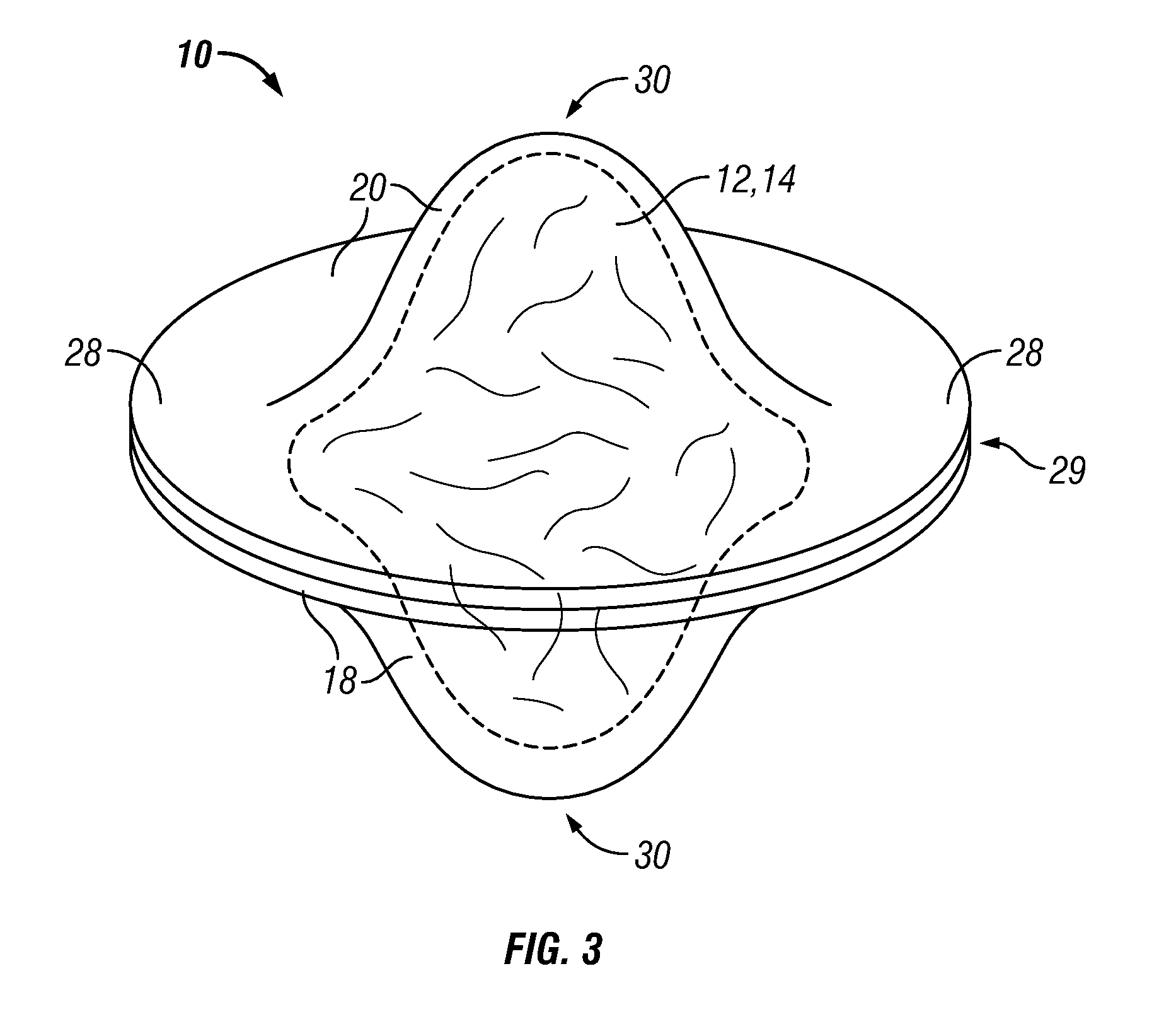 Use of Foam Shape Memory Polymer To Transport Acid or Other Wellbore Treatments