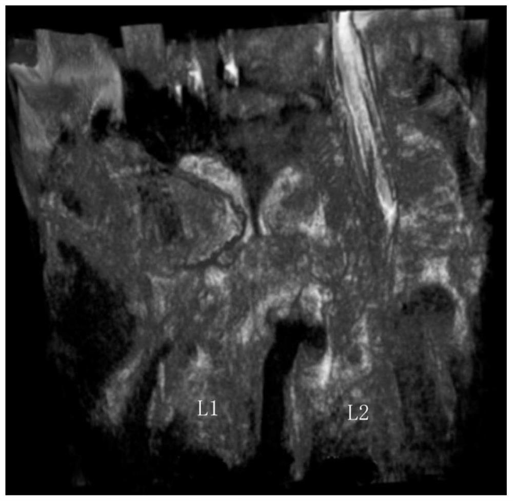 Postoperative screw placement precision evaluation method