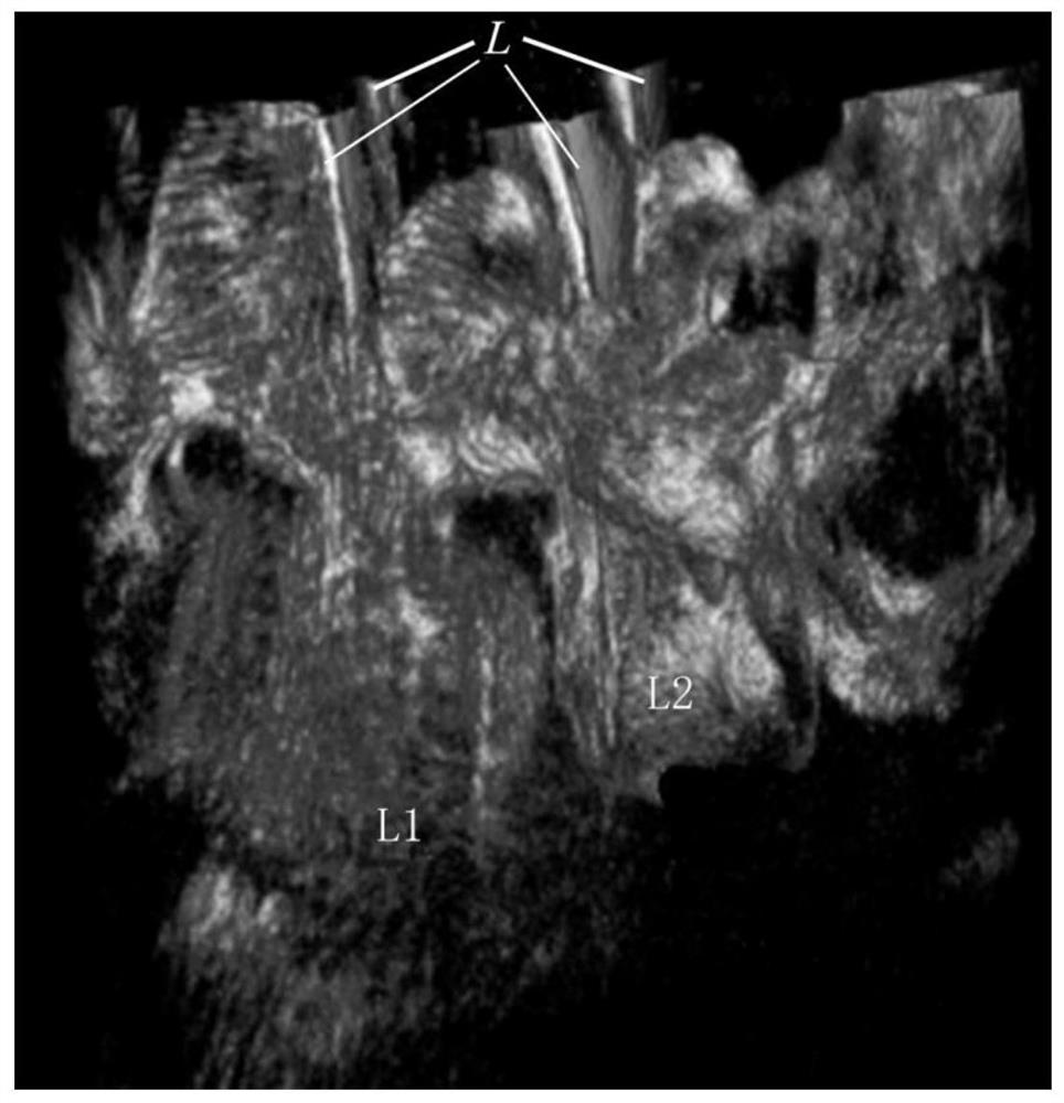 Postoperative screw placement precision evaluation method