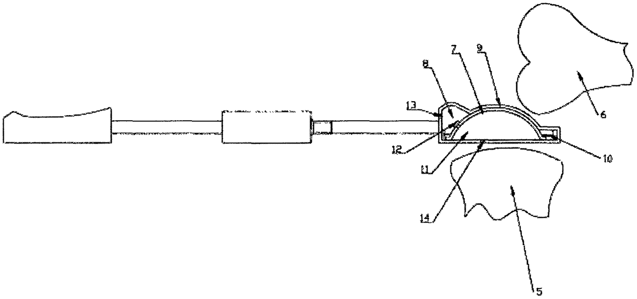 Liner trial mold used for unicompartmental knee arthroplasty operation and matched use method