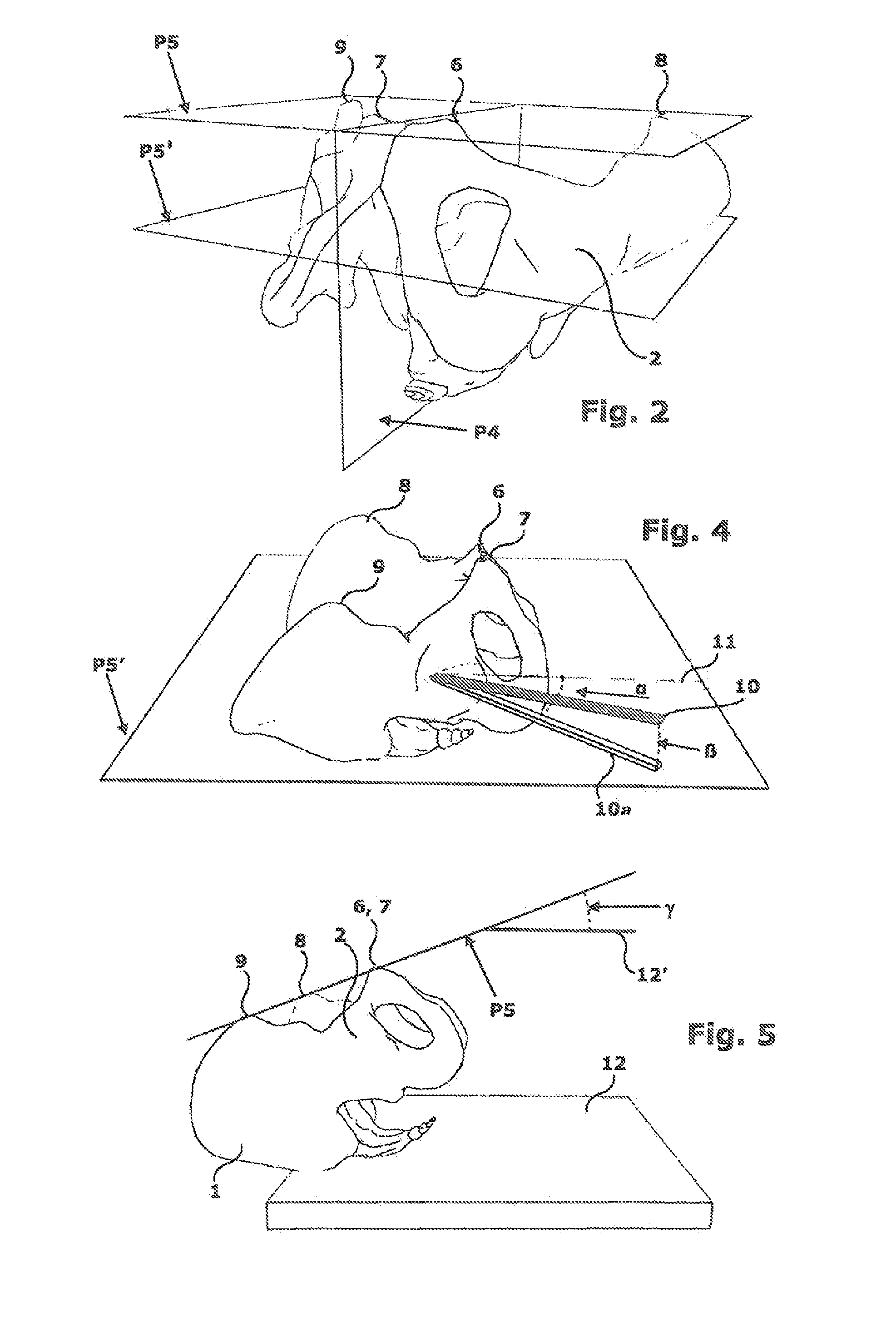 Apparatus for the orientation and positioning of surgical instruments and of implantation prosthesis in a bone seat