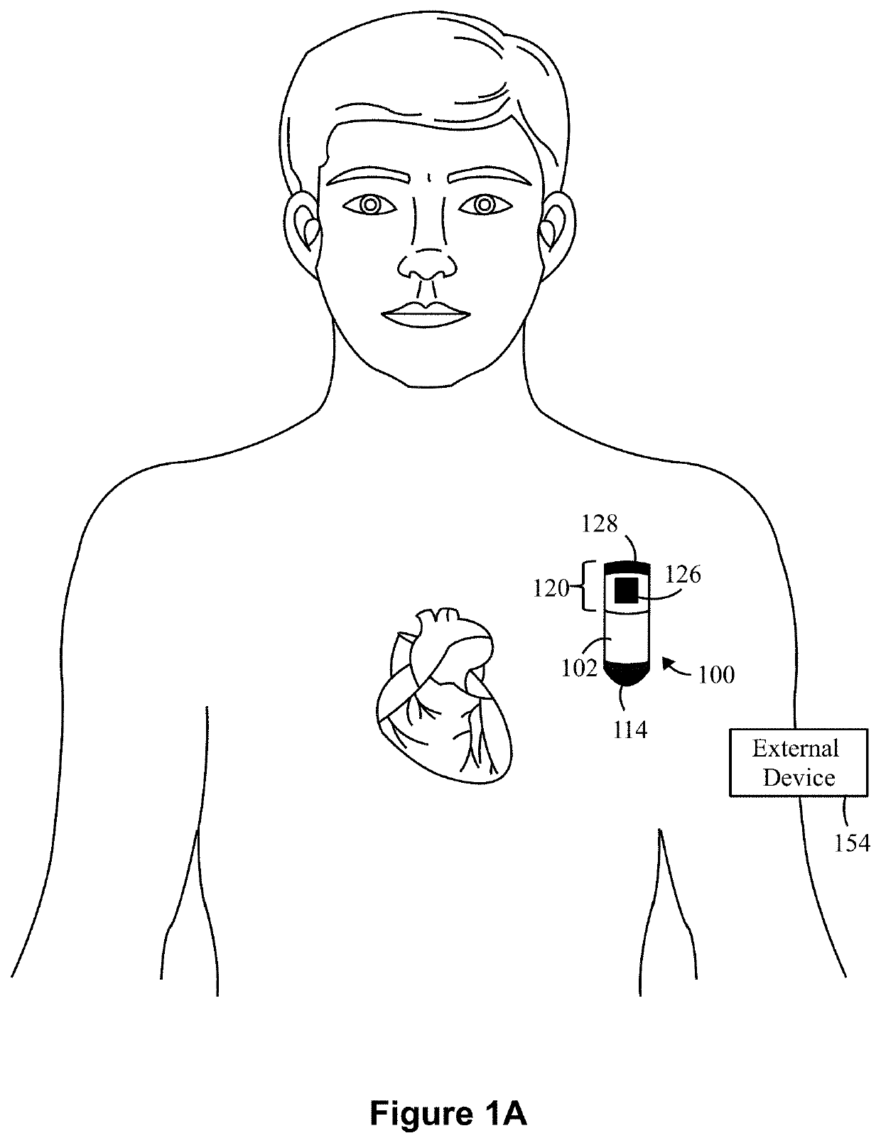 Method and system to detect r-waves in cardiac activity signals