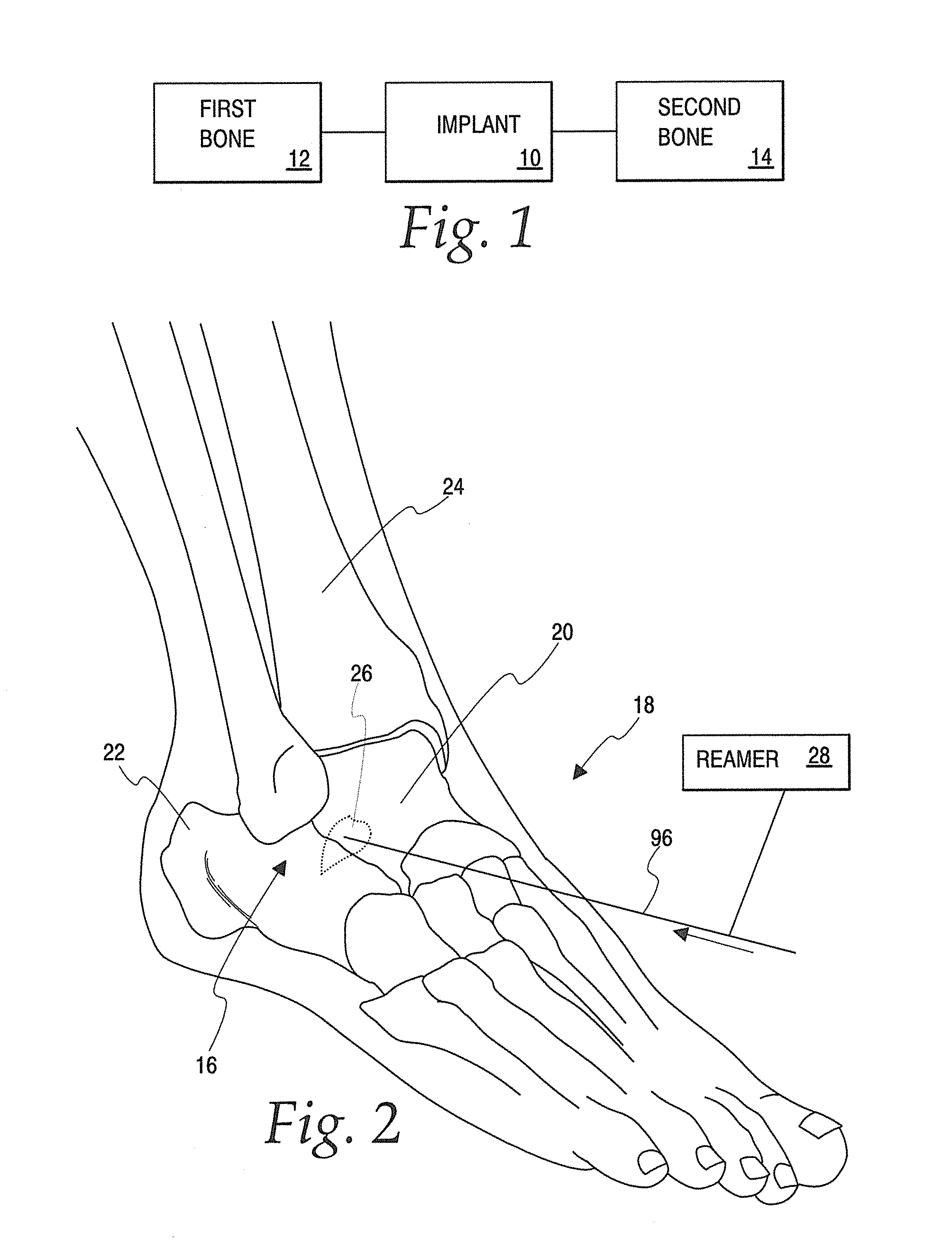 Implant for fixation of first and second bones and method of fixing first and second bones using the implant