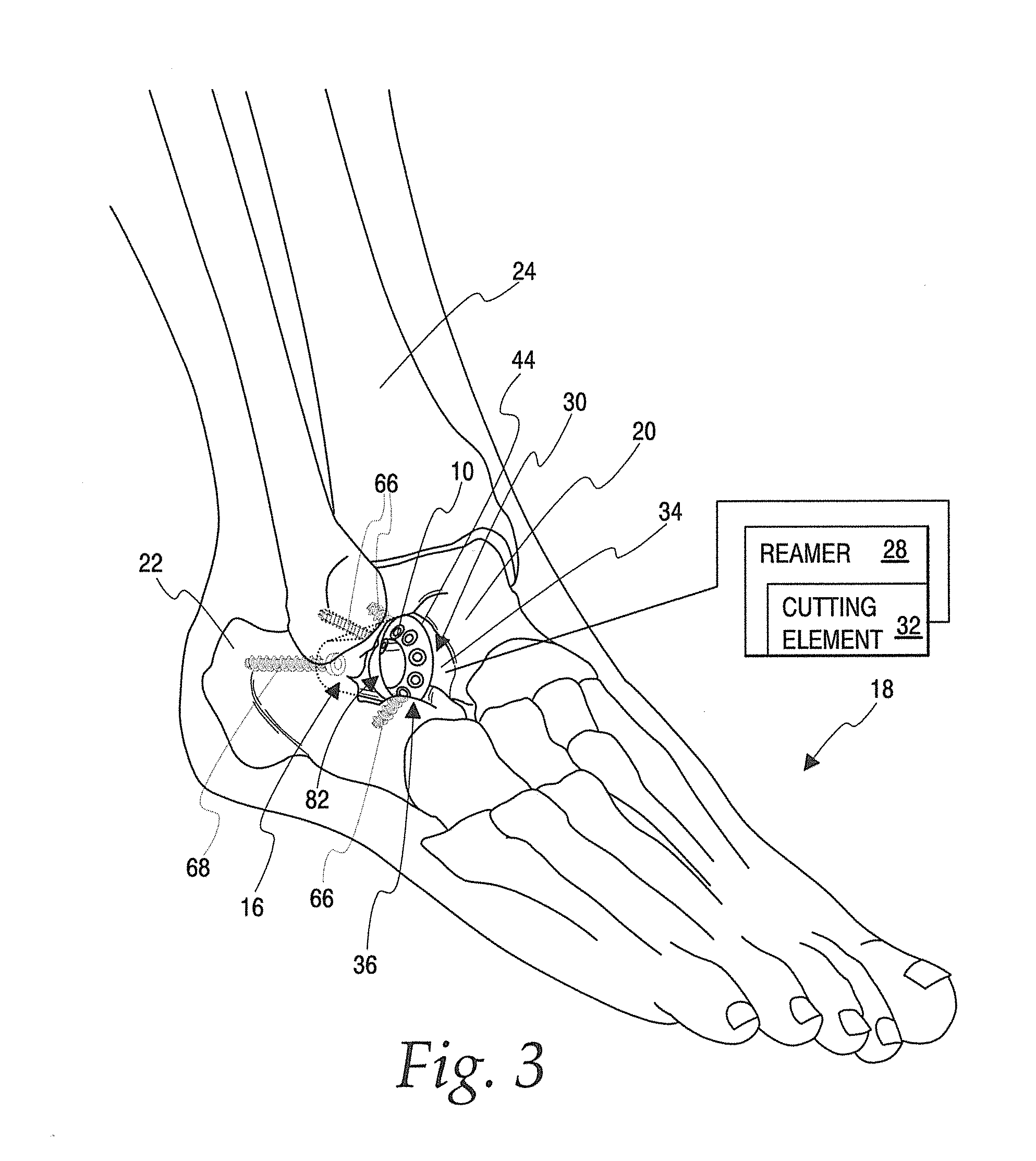 Implant for fixation of first and second bones and method of fixing first and second bones using the implant